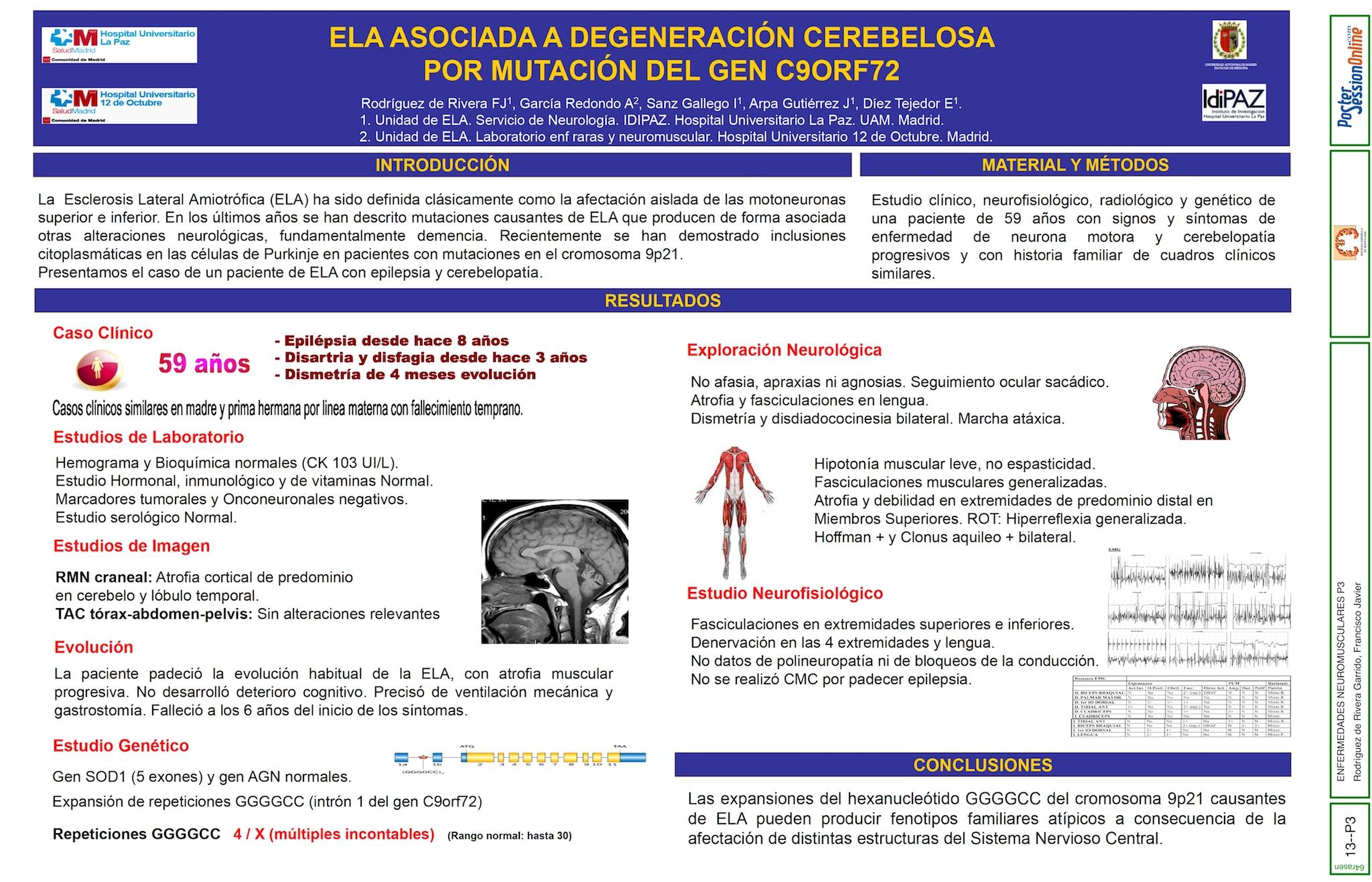 ELA asociada a degeneración cerebelosa por mutación del gen C9orf72.