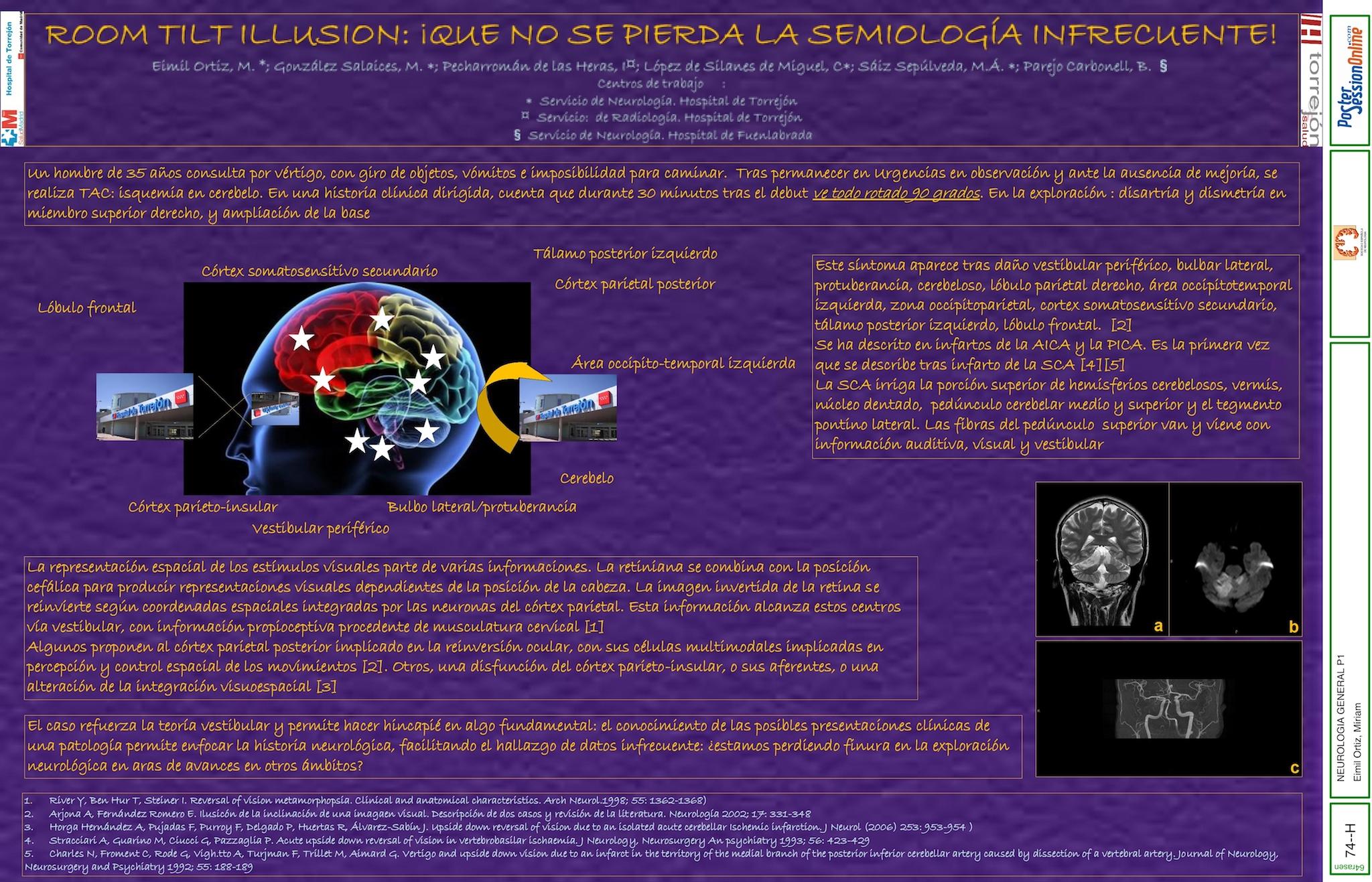 “ROOM TILT ILUSION”:  ¡ QUE NO PERDAMOS LA SEMIOLOGÍA INFRECUENTE!