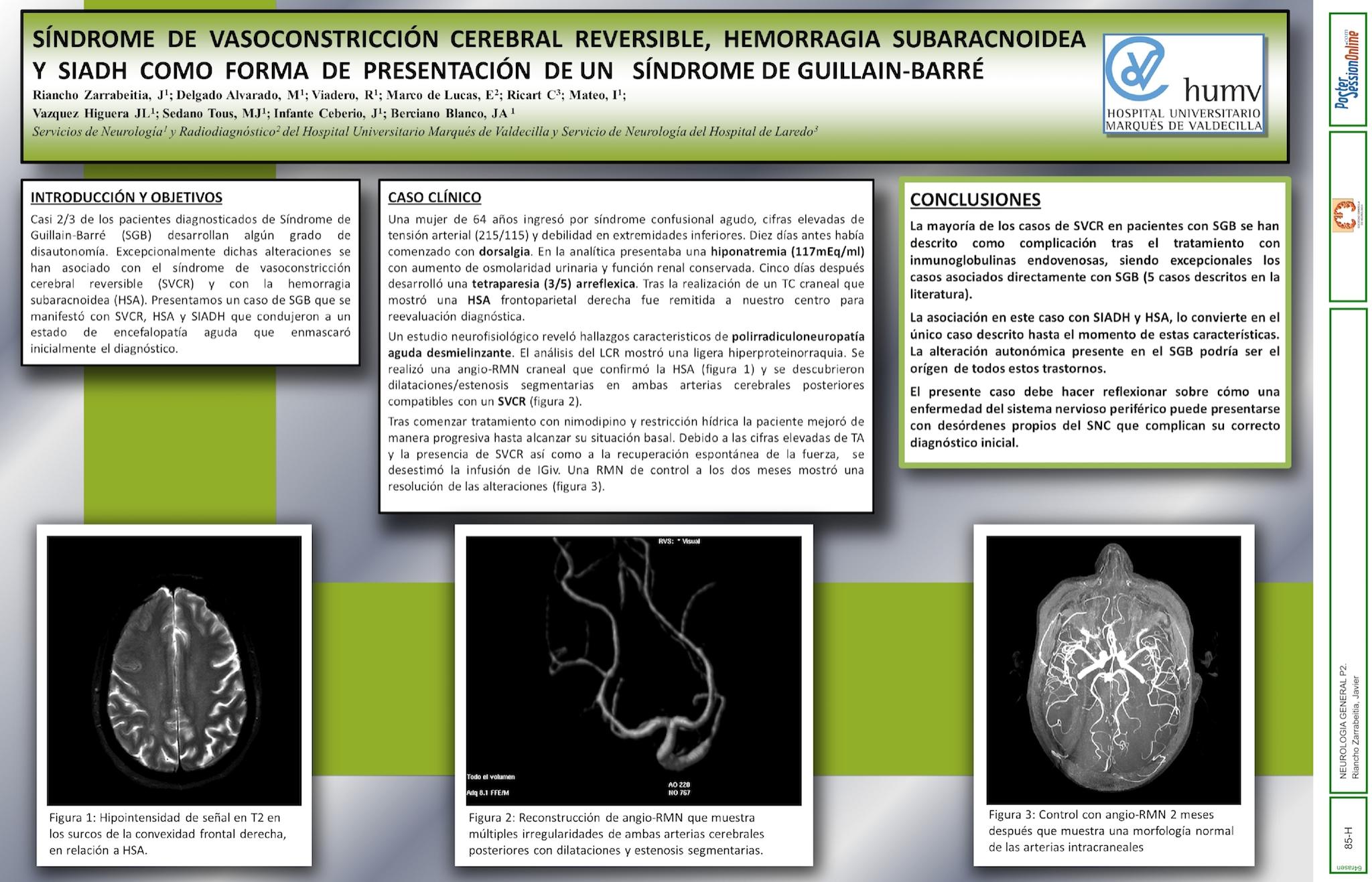 Síndrome de vasoconstricción cerebral reversible, hemorragia subaracnoidea y SIADH como forma de presentación de un síndrome de Guillain-Barré
