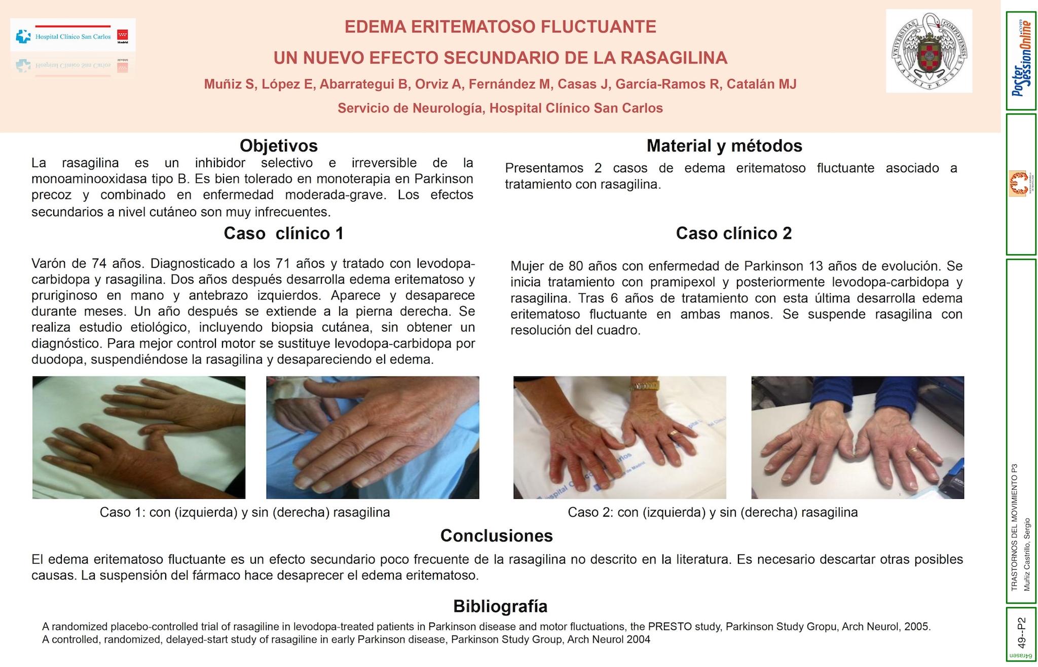 EDEMA ERITEMATOSO FLUCTUANTE. UN NUEVO EFECTO SECUNDARIO DE LA RASAGILINA