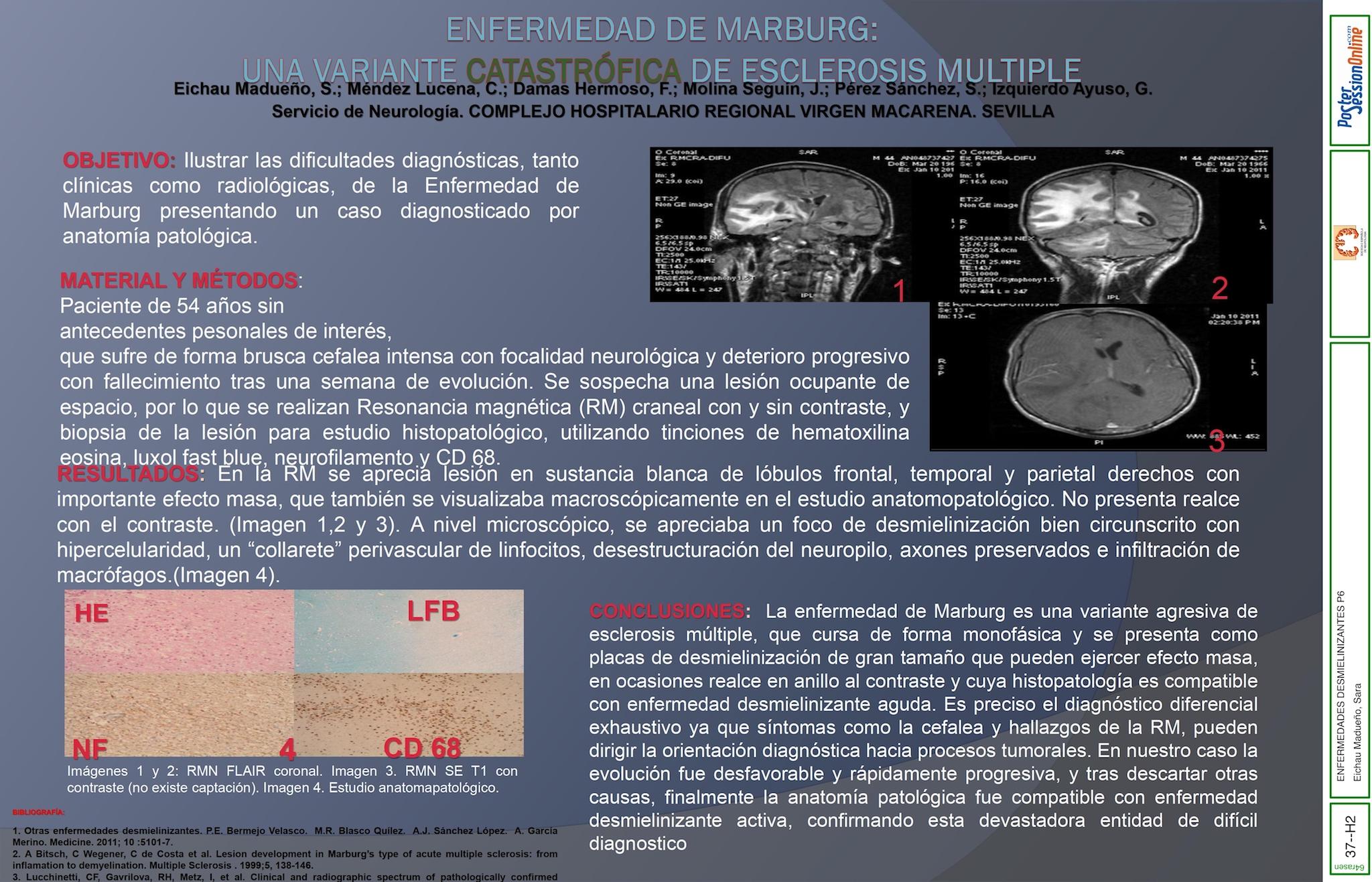 ENFERMEDAD DE MARBURG: UNA VARIANTE CATASTRÓFICA DE ESCLEROSIS MULTIPLE.