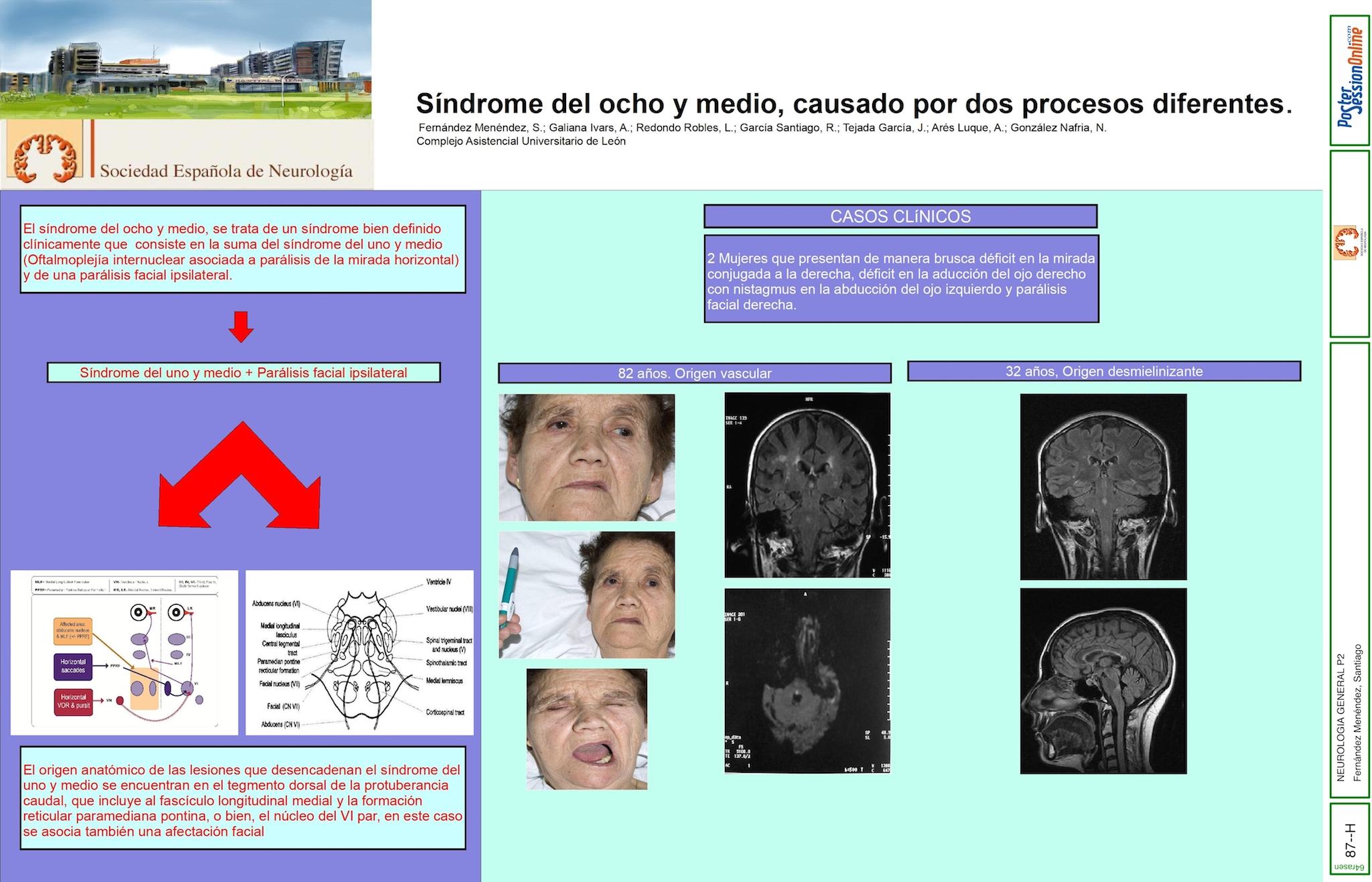 síndrome del ocho y medio, causado por dos procesos diferentes
