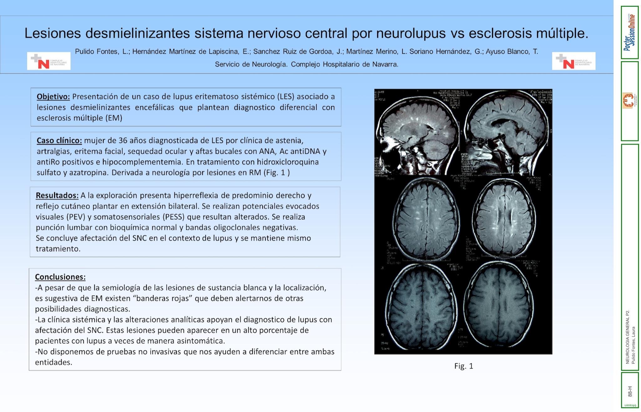 Lesiones desmielinizantes sistema nervioso central por neurolupus vs esclerosis multiple