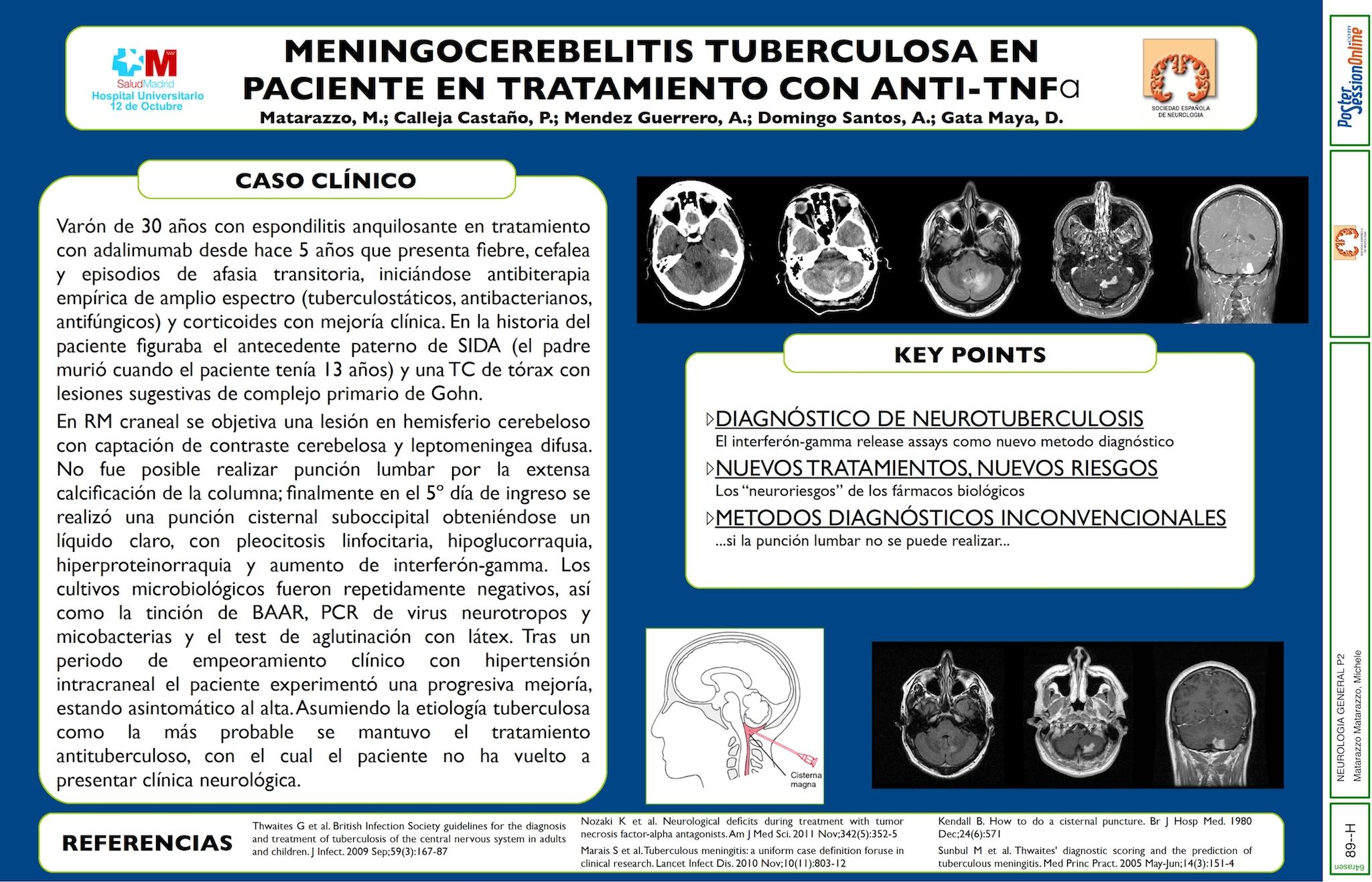 Meningocerebelitis tuberculosa en paciente en tratamiento con adalimumab