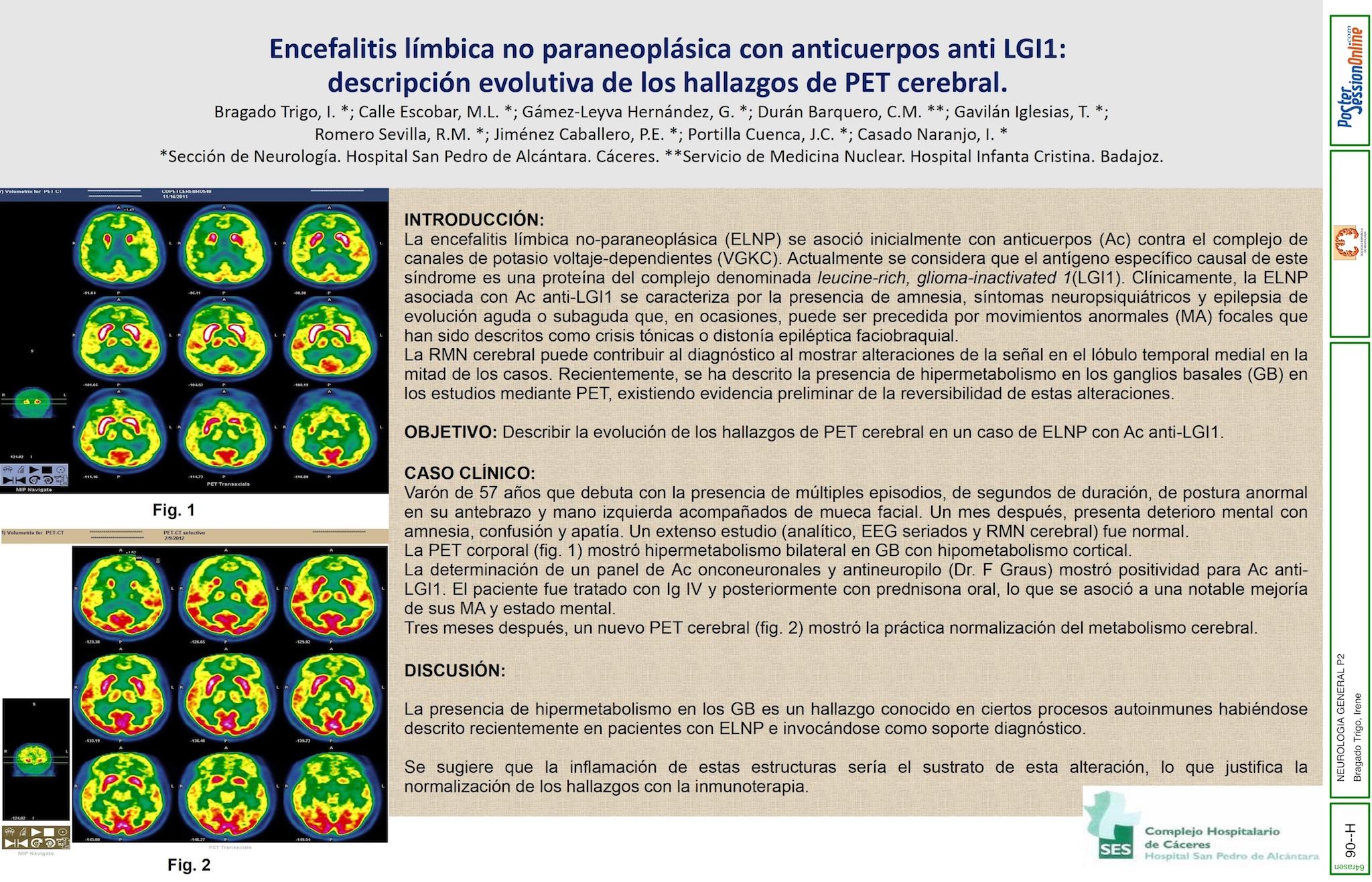 Encefalitis límbica no paraneoplásica con anticuerpos anti LGI1: descripción evolutiva de los hallazgos de PET cerebral.