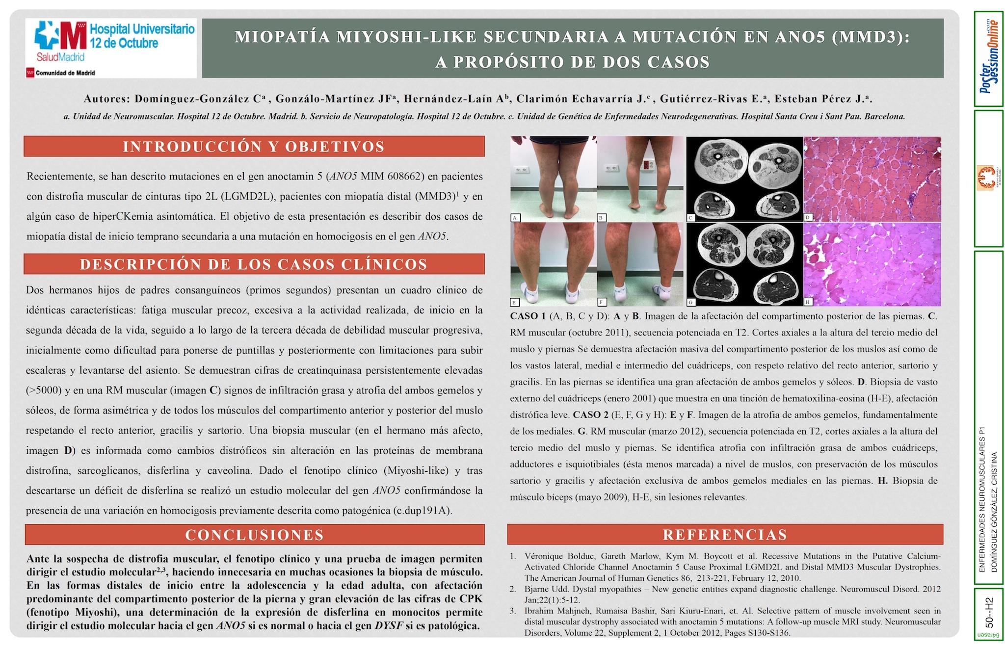 MIOPATÍA MIYOSHI-LIKE SECUNDARIA A MUTACIÓN EN EL GEN ANO5 (MMD3): A PROPÓSITO DE DOS CASOS