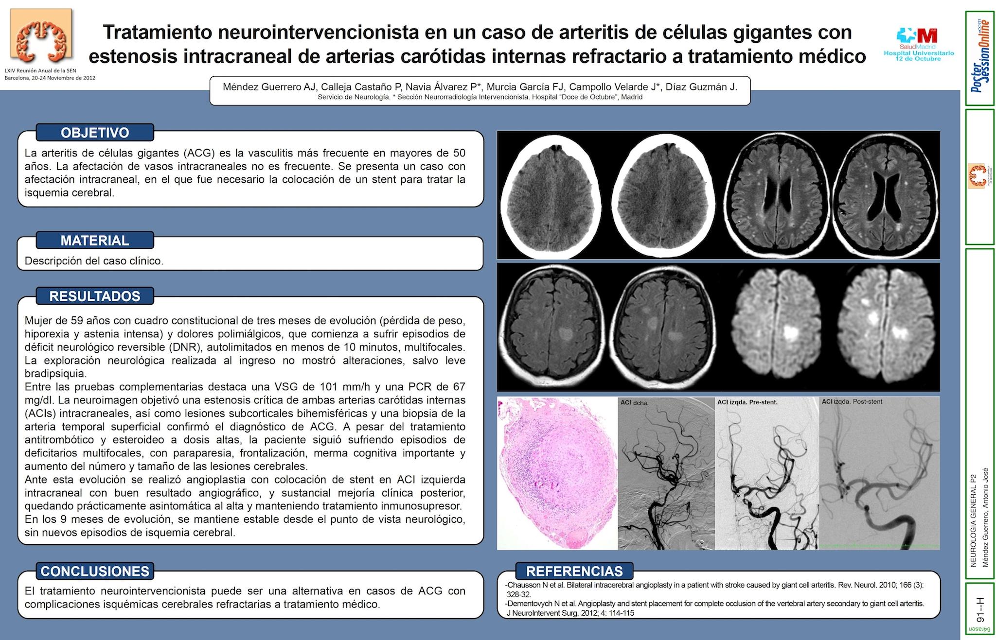 Tratamiento neurointervencionista en un caso de arteritis de células gigantes con estenosis intracraneal de arterias carótidas internas refractario a tratamiento médico