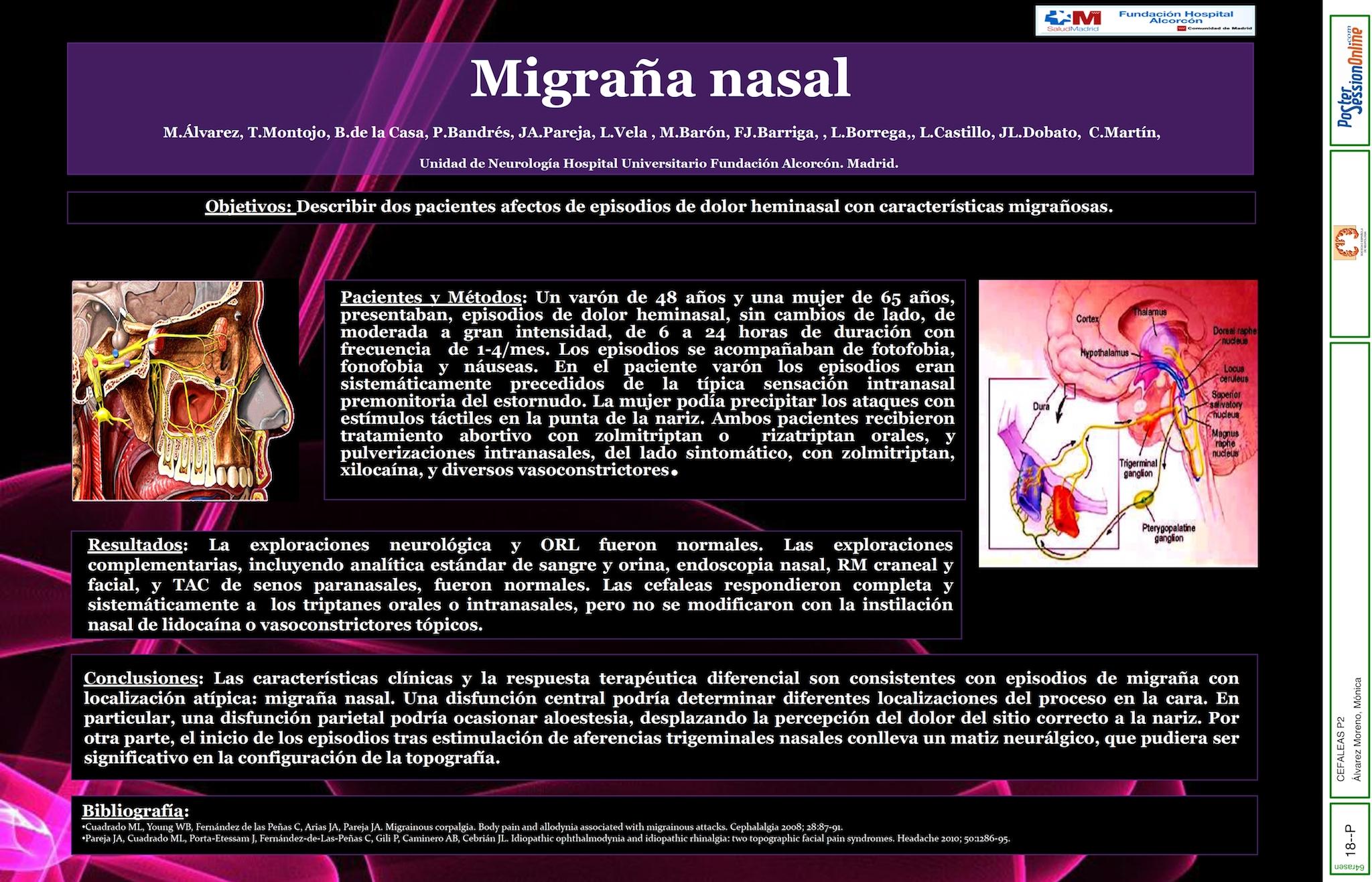 Migraña nasal