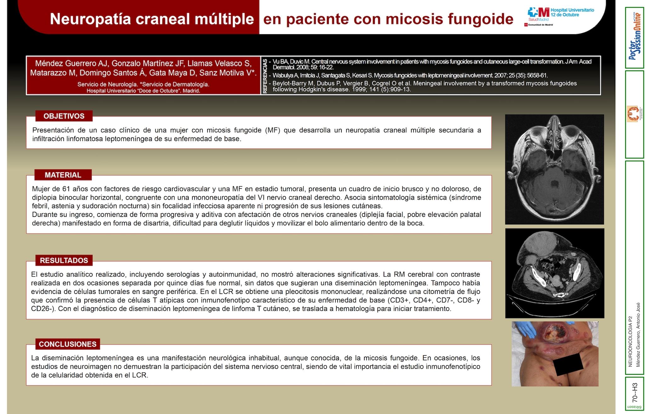Neuropatía craneal múltiple en paciente con micosis fungoide