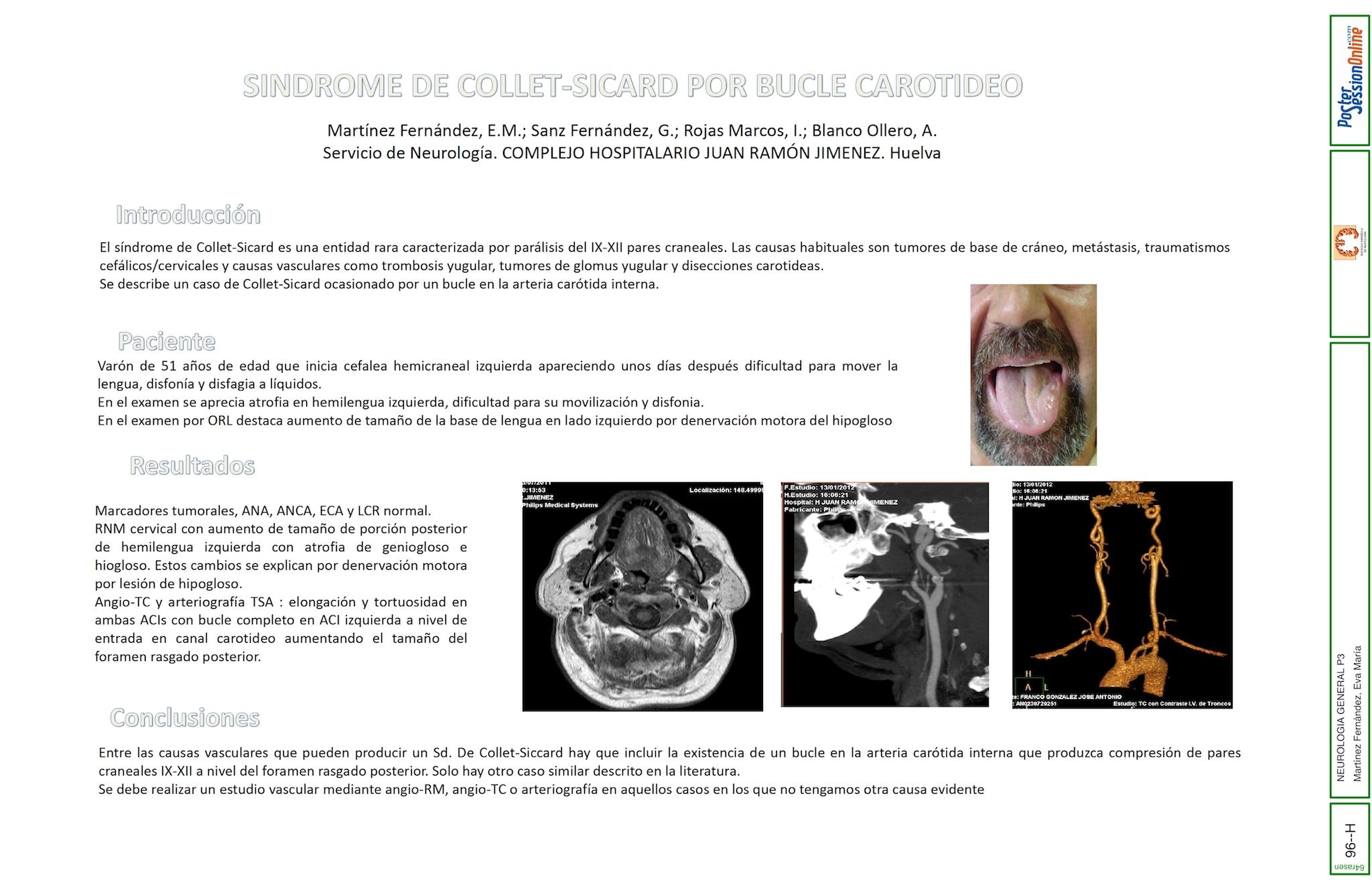 SINDROME DE COLLET-SICARD POR BUCLE CAROTIDEO