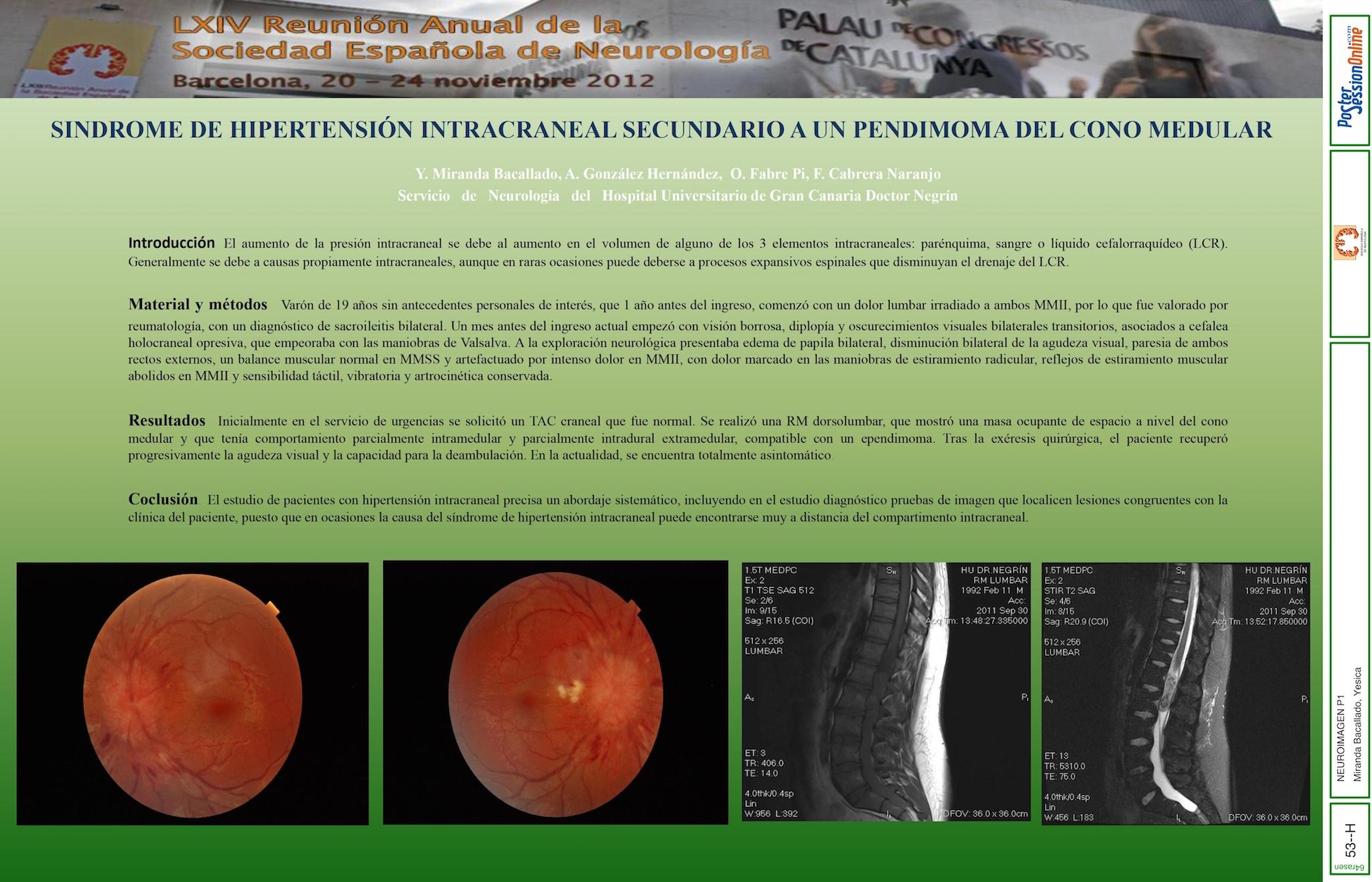 Síndrome de Hipertensión intracraneal secundario a un ependimoma del cono medular