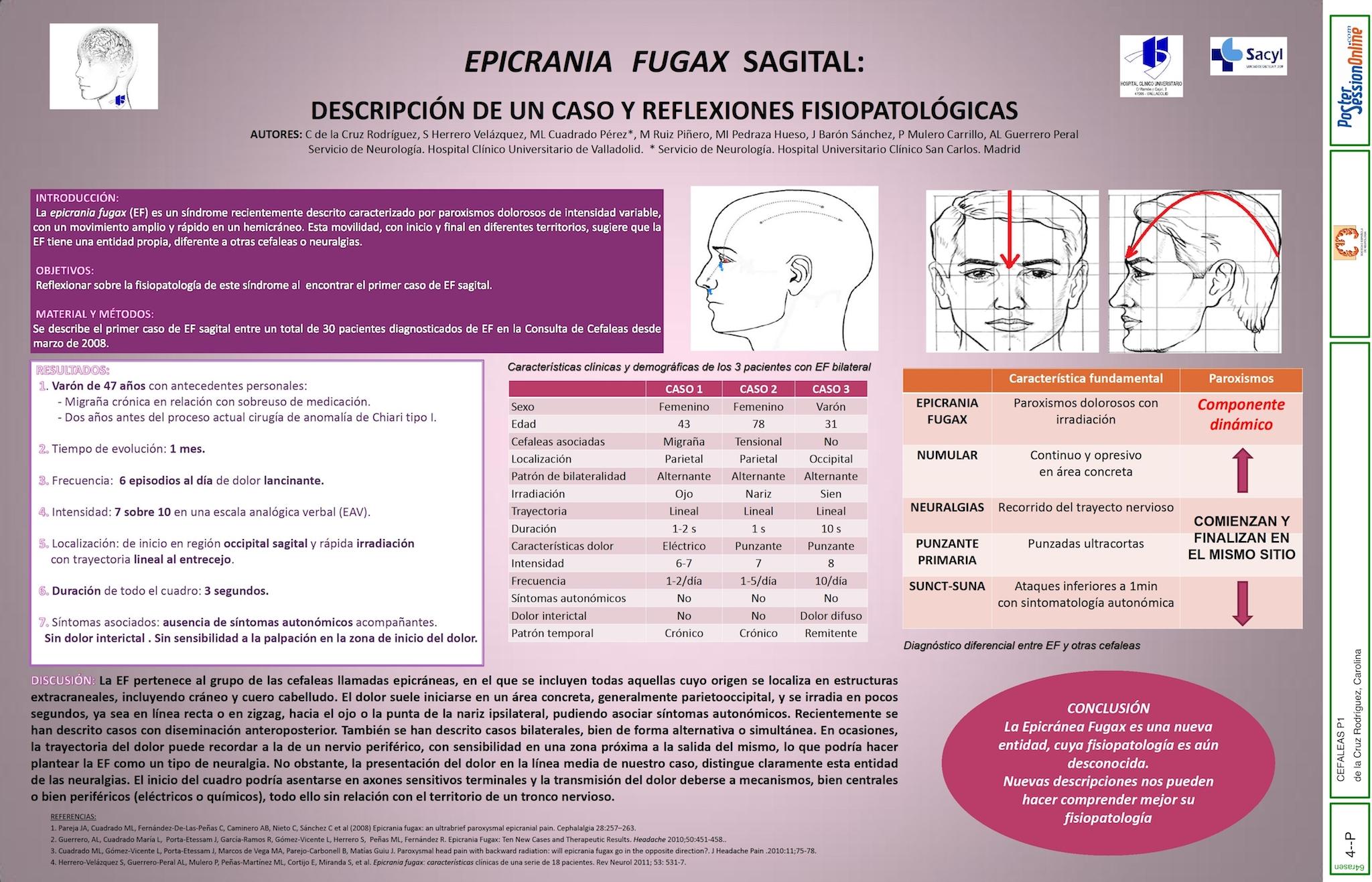 EPICRANIA FUGAX SAGITAL: DESCRIPCIÓN DE UN CASO Y REFLEXIONES FISIOPATOLÓGICAS