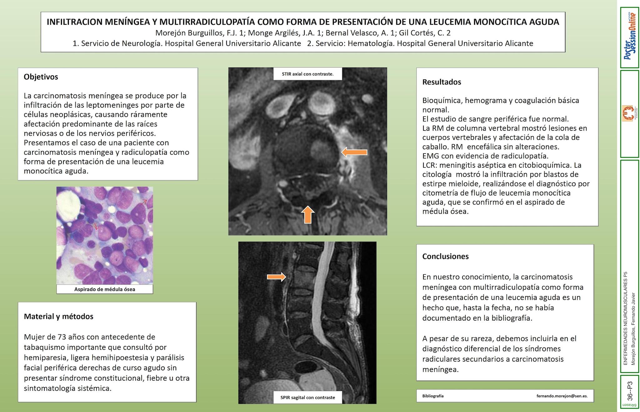 INFILTRACION MENÍNGEA Y MULTIRRADICULOPATÍA COMO FORMA DE PRESENTACIÓN DE UNA LEUCEMIA MONOCITICA AGUDA