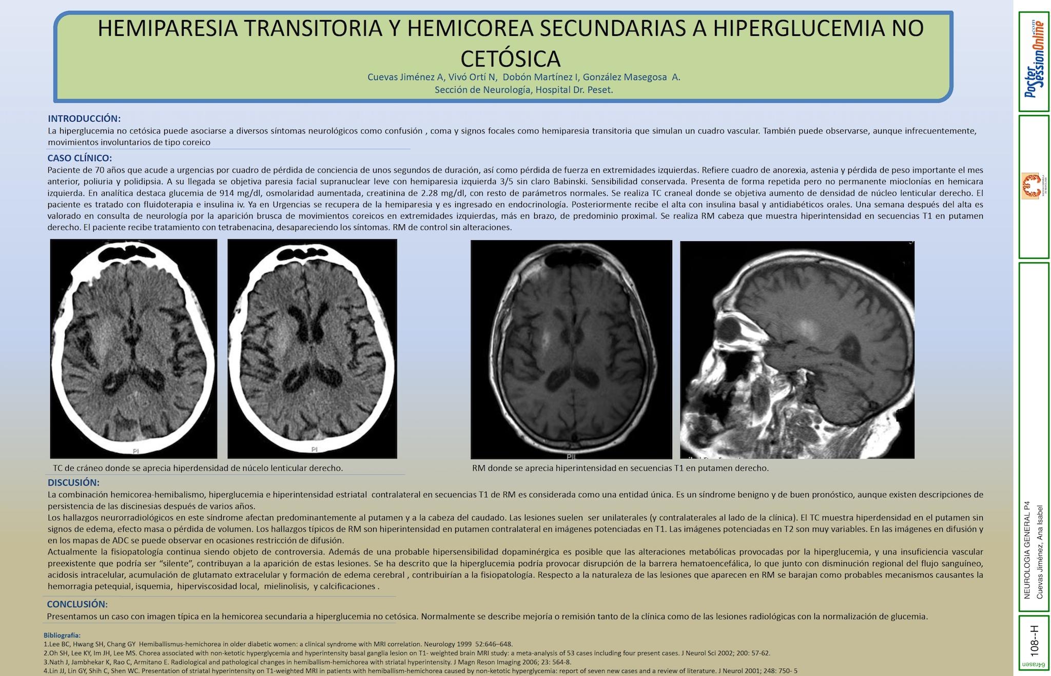 HEMIPARESIA TRANSITORIA Y HEMICOREA SECUNDARIAS A HIPERGLUCEMIA NO CETÓSICA