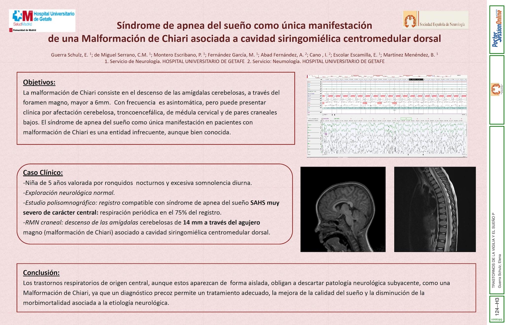 Síndrome de apnea del sueño como única manifestación de una Malformación de Chiari asociada a cavidad siringomiélica centromedular dorsal.