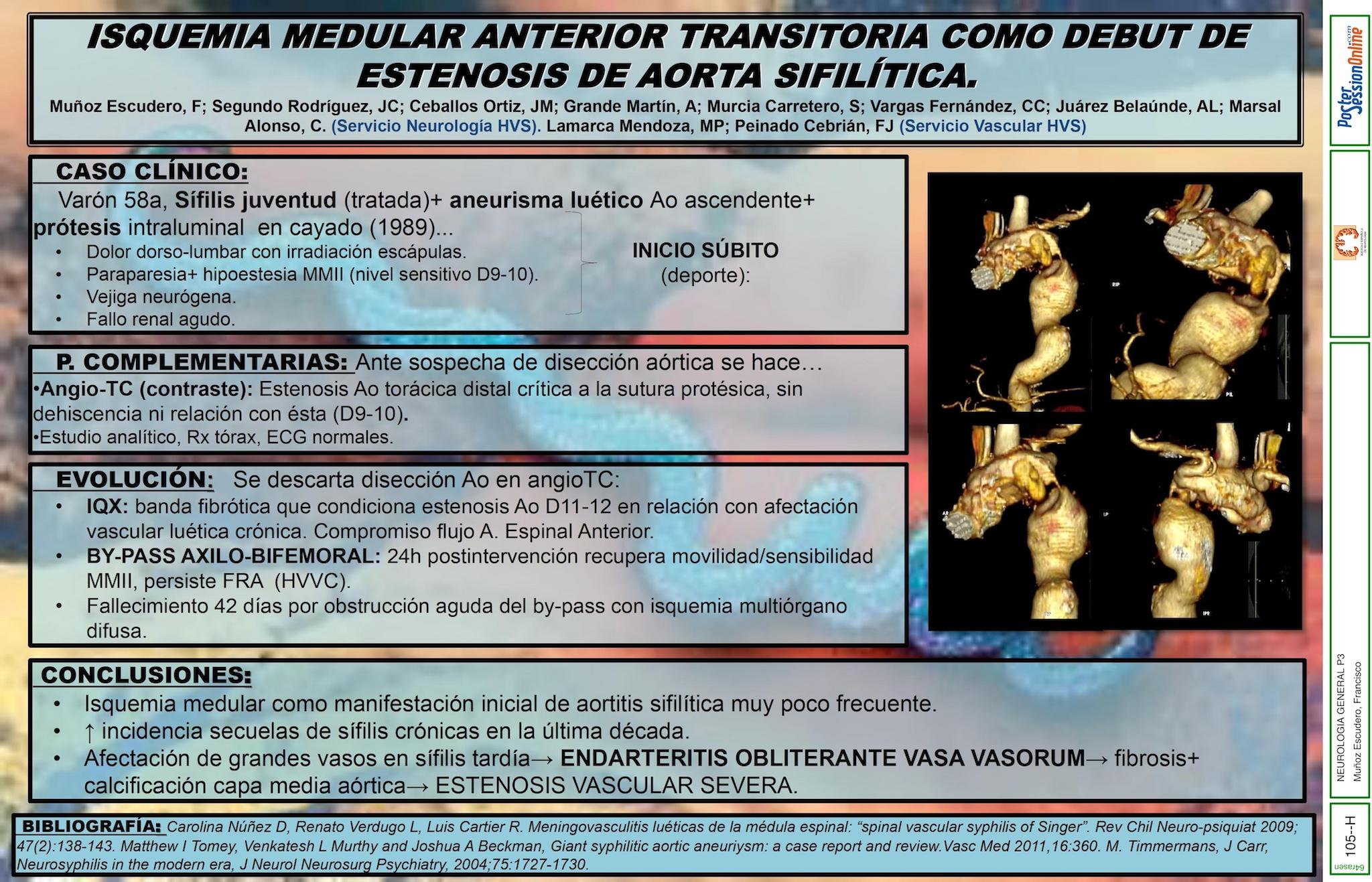 ISQUEMIA MEDULAR ANTERIOR TRANSITORIA COMO DEBUT DE COARTACIÓN DE AORTA SIFILÍTICA. A PROPÓSITO DE UN CASO.