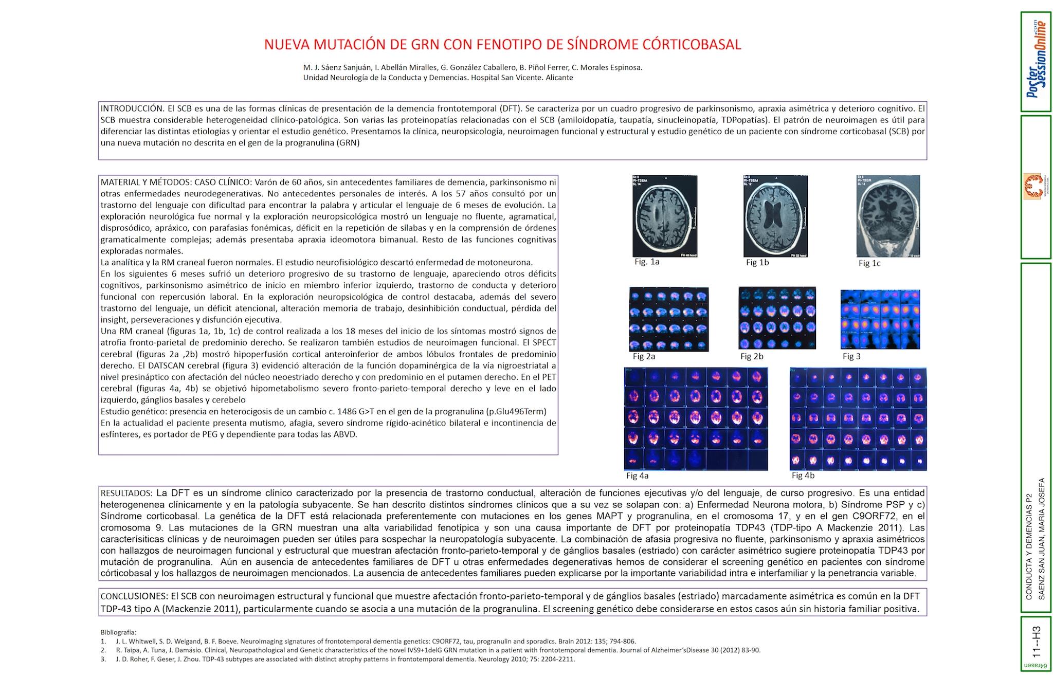 NUEVA MUTACIÓN DE GRN CON FENOTIPO DE SÍNDROME CORTICOBASAL