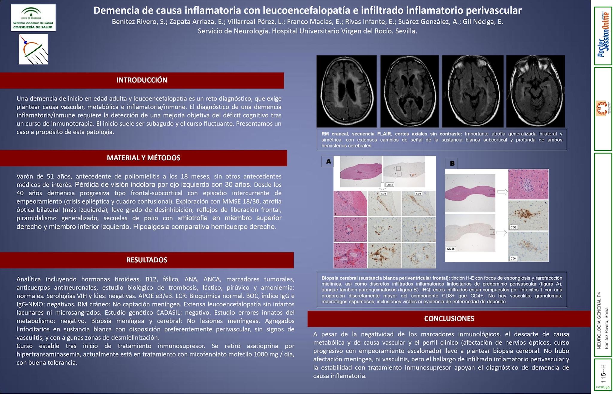 Demencia de causa inflamatoria con leucoencefalopatía e infiltrado inflamatorio perivascular