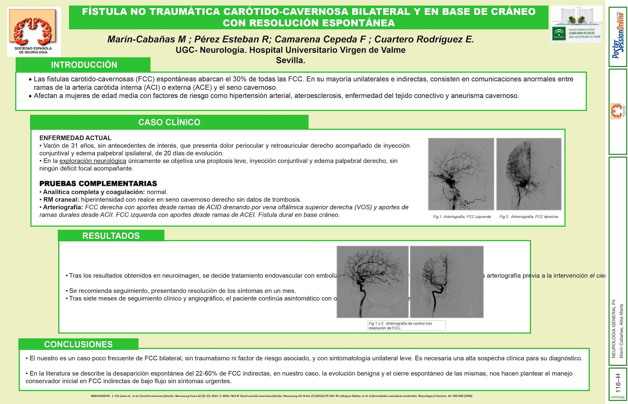 FÍSTULA NO TRAUMÁTICA CARÓTIDO-CAVERNOSA BILATERAL Y EN BASE DE CRÁNEO CON RESOLUCIÓN  ESPONTÁNEA