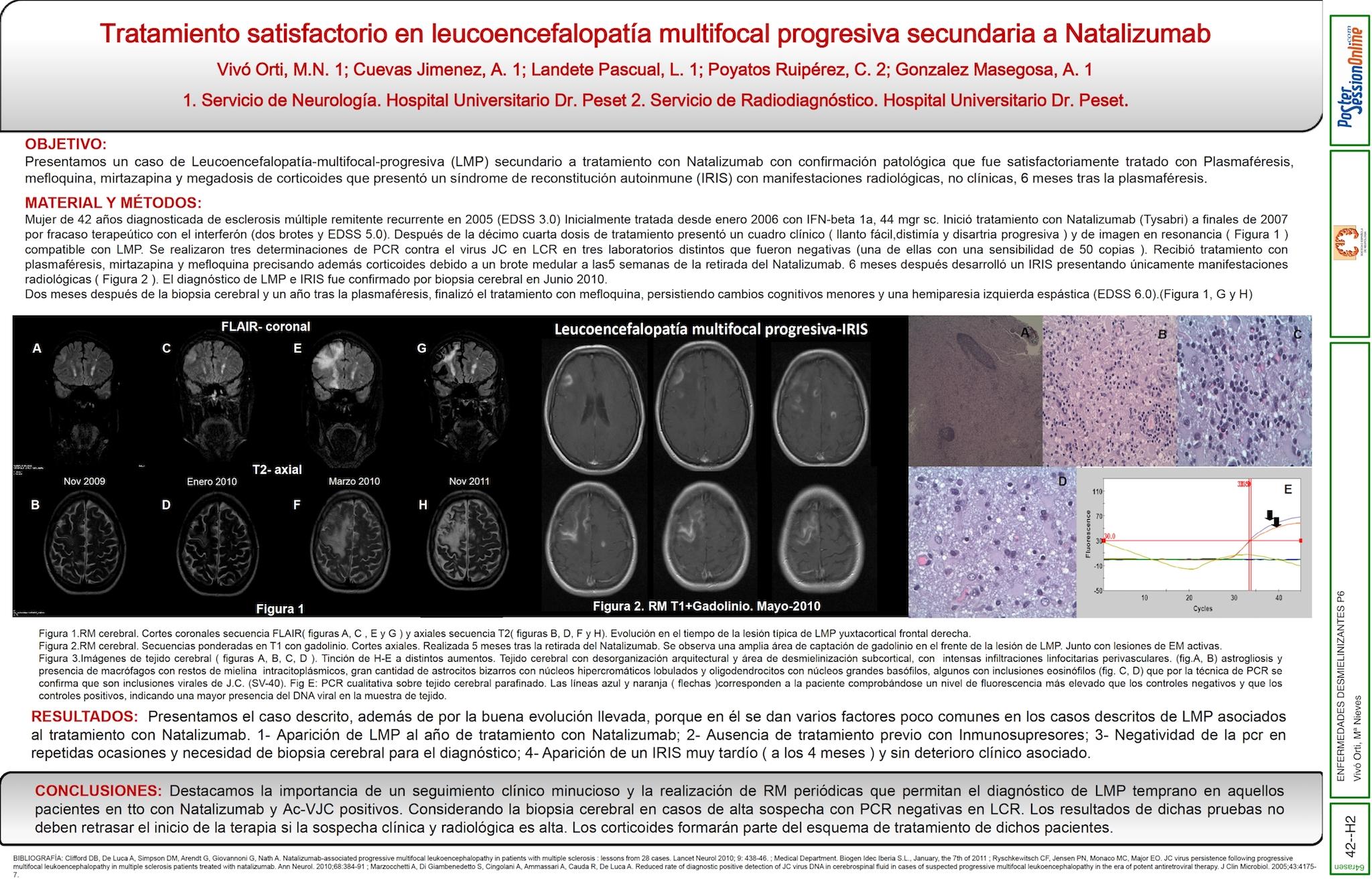 Tratamiento satisfactorio en leucoencefalopatía multifocal progresiva secundaria a Natalizumab