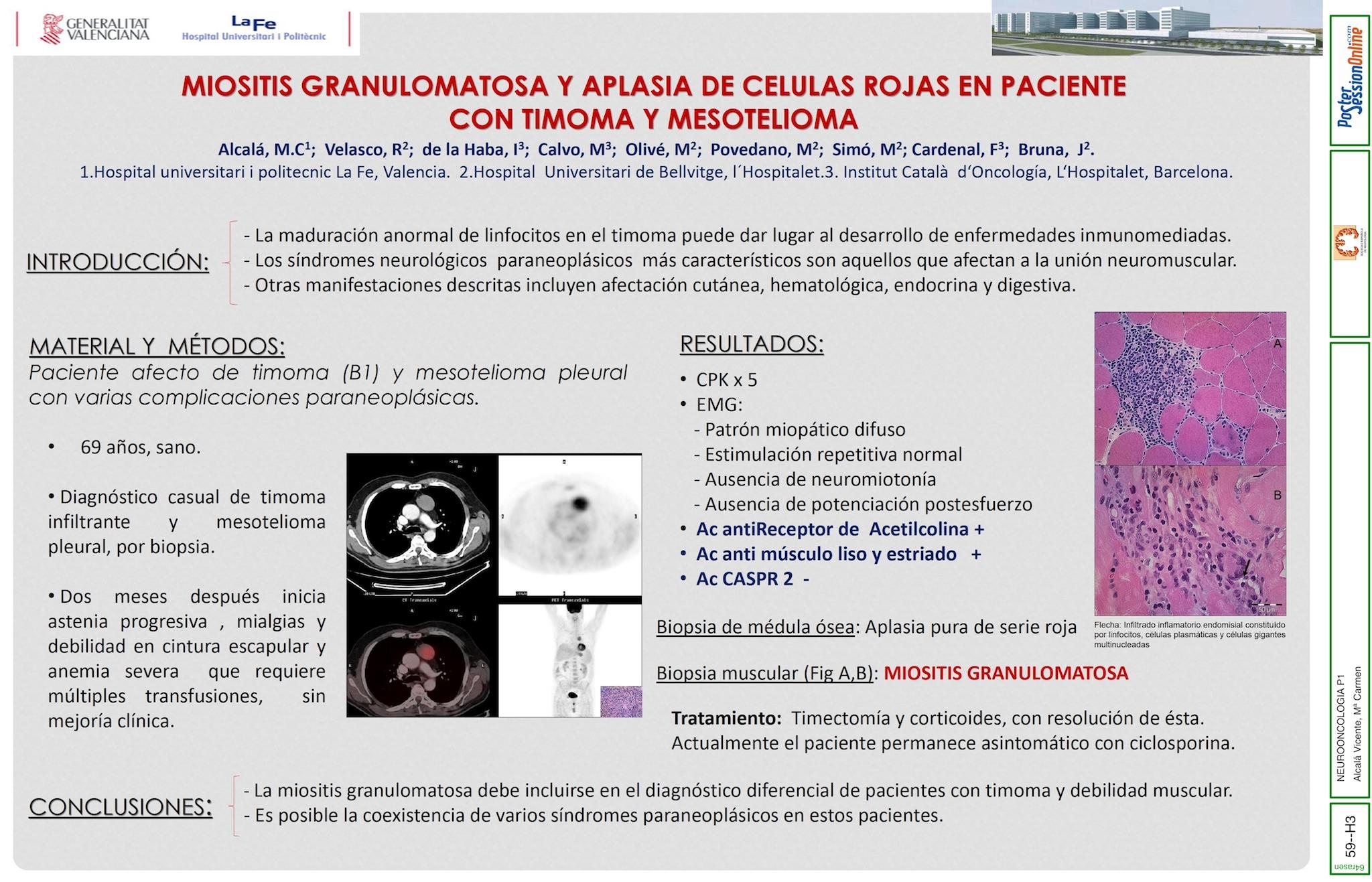 MIOSITIS GRANULOMATOSA Y APLASIA DE CELULAS ROJAS EN PACIENTE CON TIMOMA y MESOTELIOMA.
