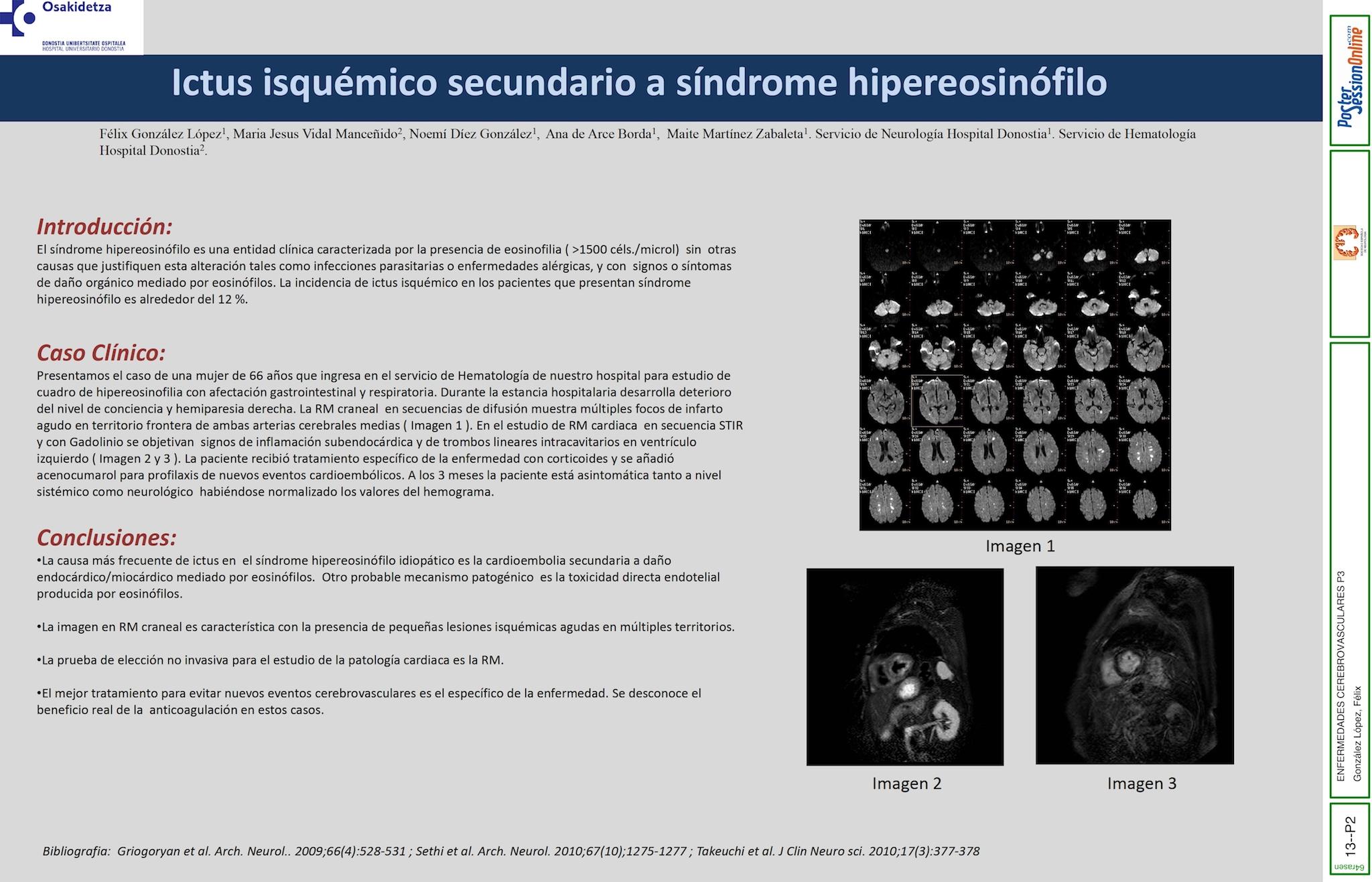 Ictus isquémico secundario a síndrome hipereosinófilo.
