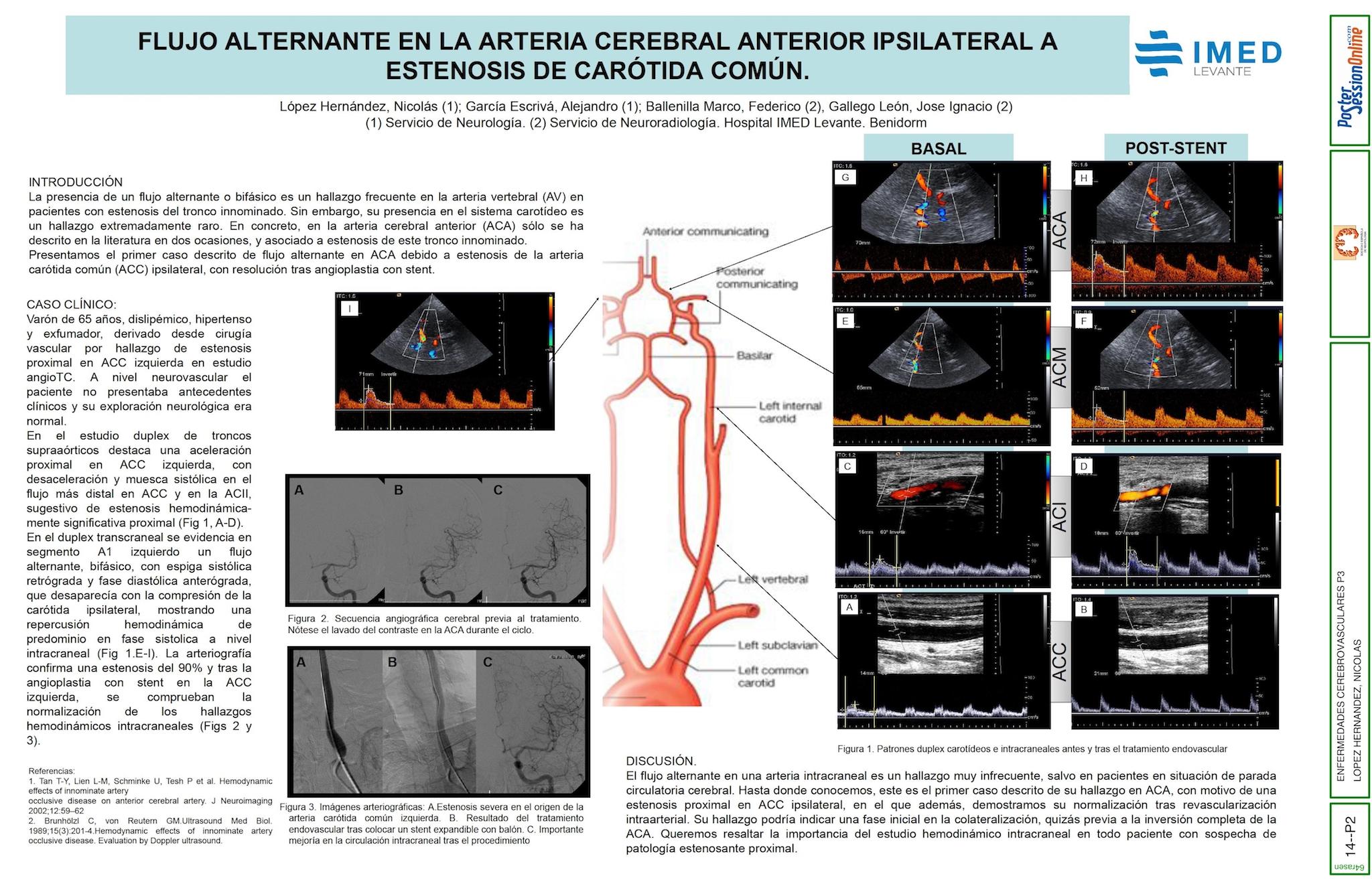 FLUJO ALTERNANTE EN LA ARTERIA CEREBRAL ANTERIOR IPSILATERAL A ESTENOSIS DE CARÓTIDA COMÚN