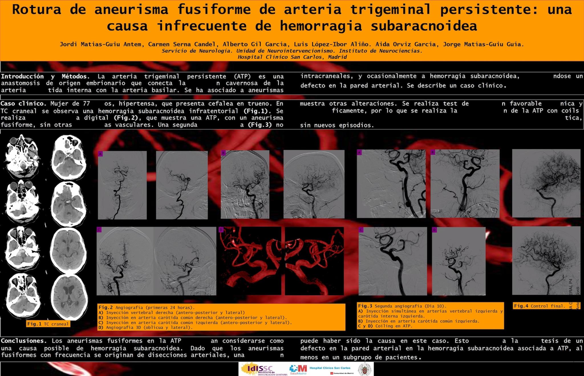 ROTURA DE ANEURISMA FUSIFORME DE ARTERIA TRIGEMINAL PERSISTENTE: UNA CAUSA INFRECUENTE DE HEMORRAGIA SUBARACNOIDEA.