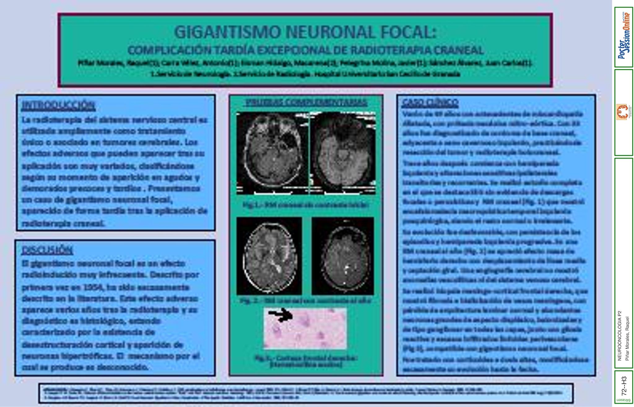Gigantismo neuronal focal: una rara complicación tardía de la radioterapia craneal.