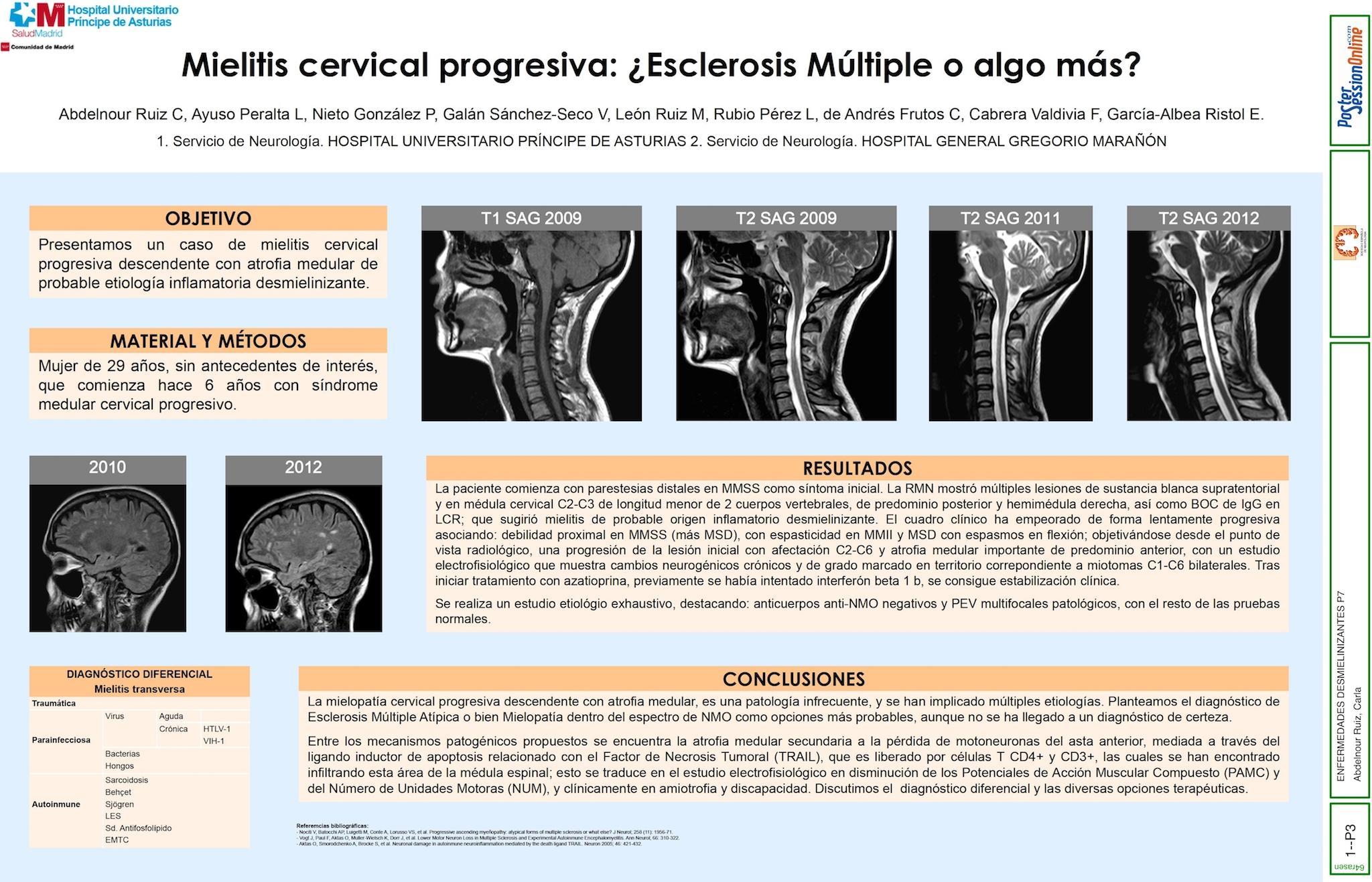 Mielitis cervical progresiva: ¿Esclerosis Múltiple o algo más?