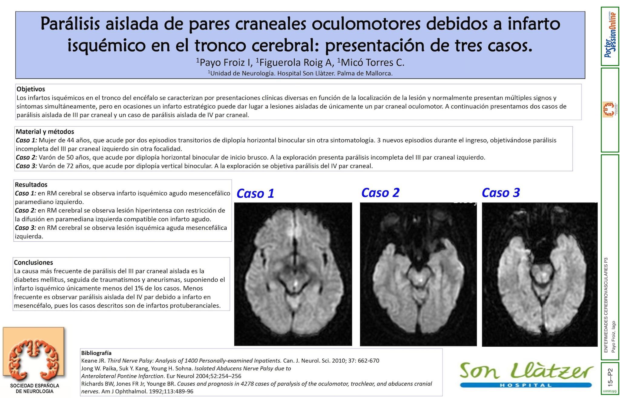 Parálisis aislada de pares craneales oculomotores debidos a infarto isquémico en el tronco cerebral. Presentación de tres casos.