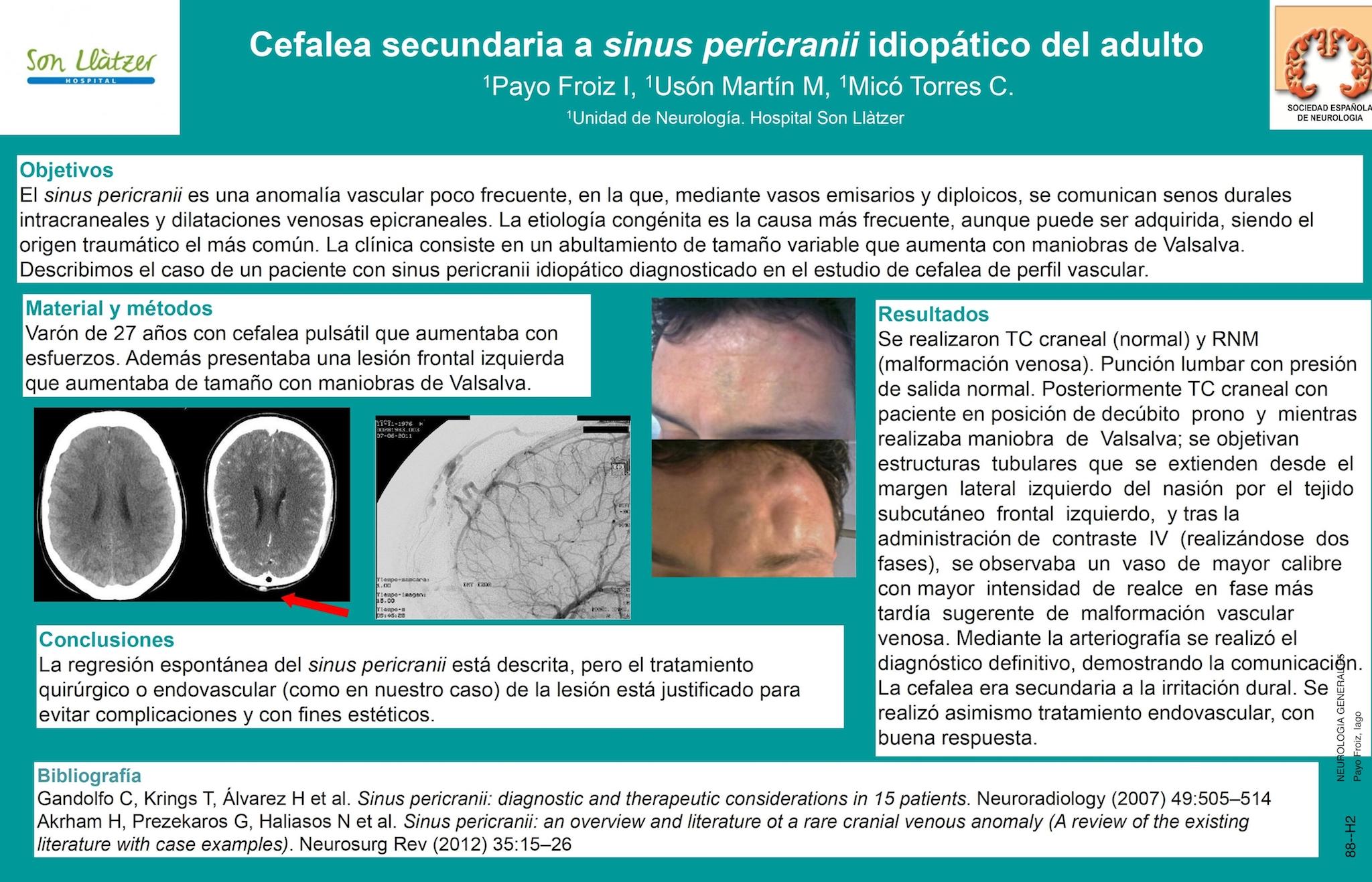 Cefalea secundaria a sinus pericranii idiopático del adulto