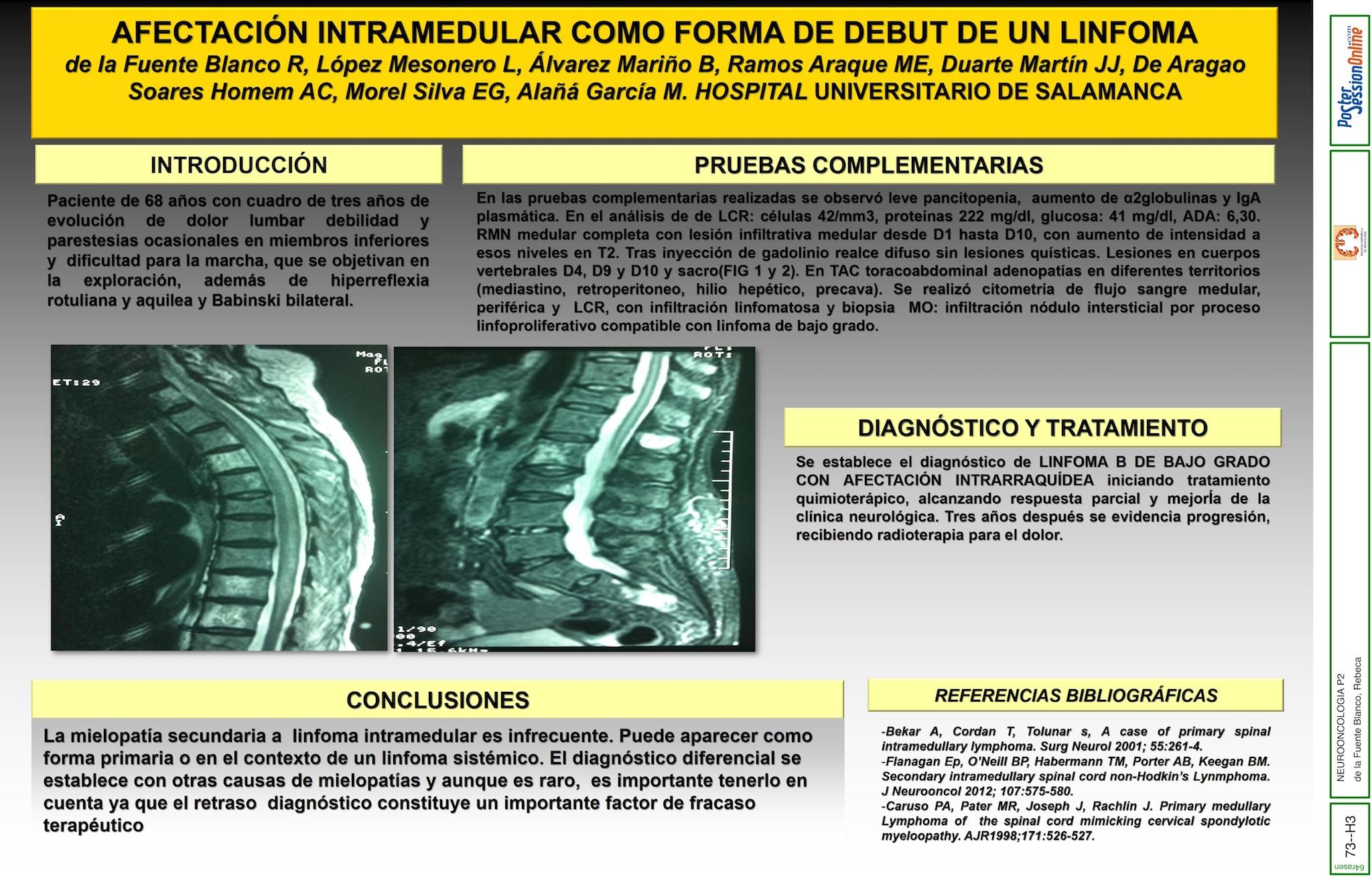 AFECTACIÓN INTRAMEDULAR COMO FORMA DE DEBUT DE UN  LINFOMA