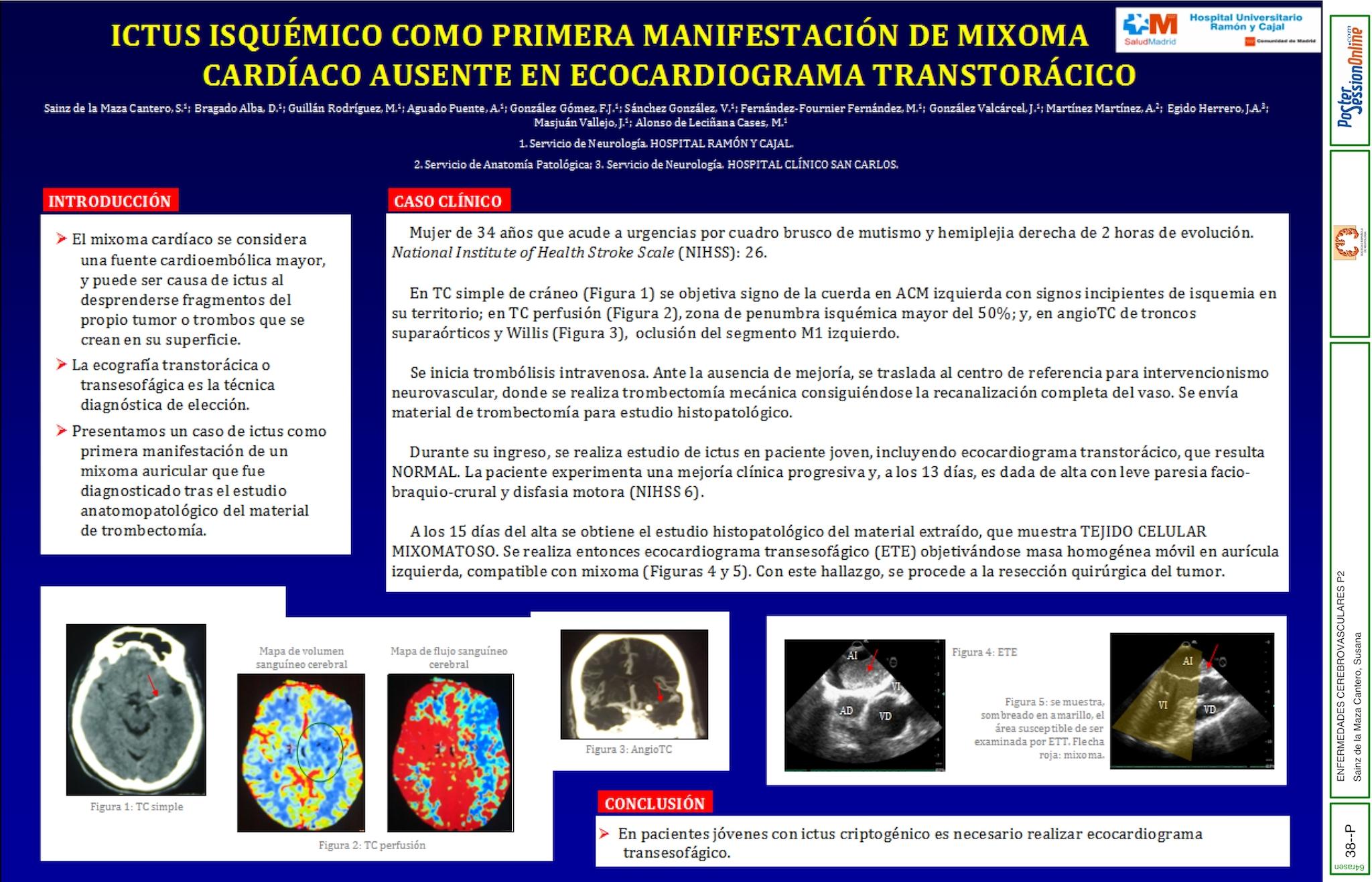 Ictus isquémico como primera manifestación de mixoma cardíaco ausente en ecocardiograma transtorácico
