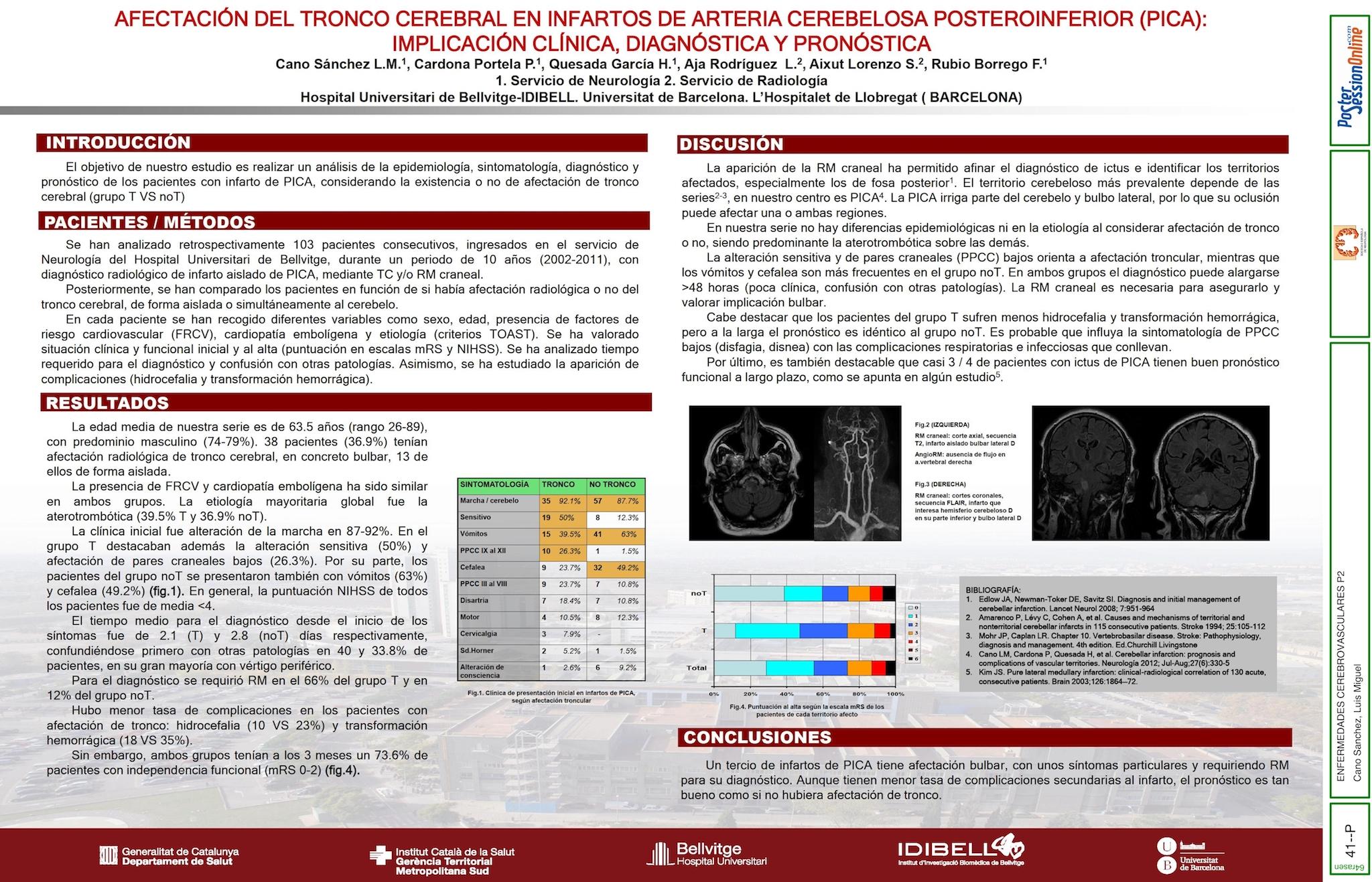 Afectación del tronco cerebral en infartos de arteria cerebelosa posteroinferior (PICA): Implicación clínica, diagnóstica y pronóstica