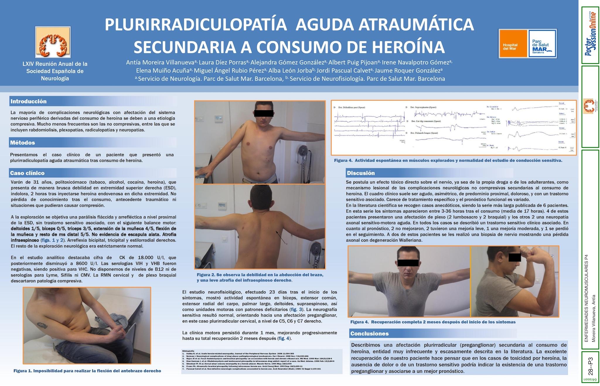 Plurirradiculopatía Aguda Atraumática Secundaria a Consumo de Heroína