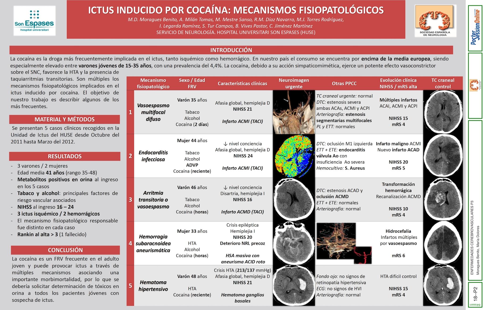 ICTUS INDUCIDO POR COCAÍNA: MECANISMOS FISIOPATOLÓGICOS.