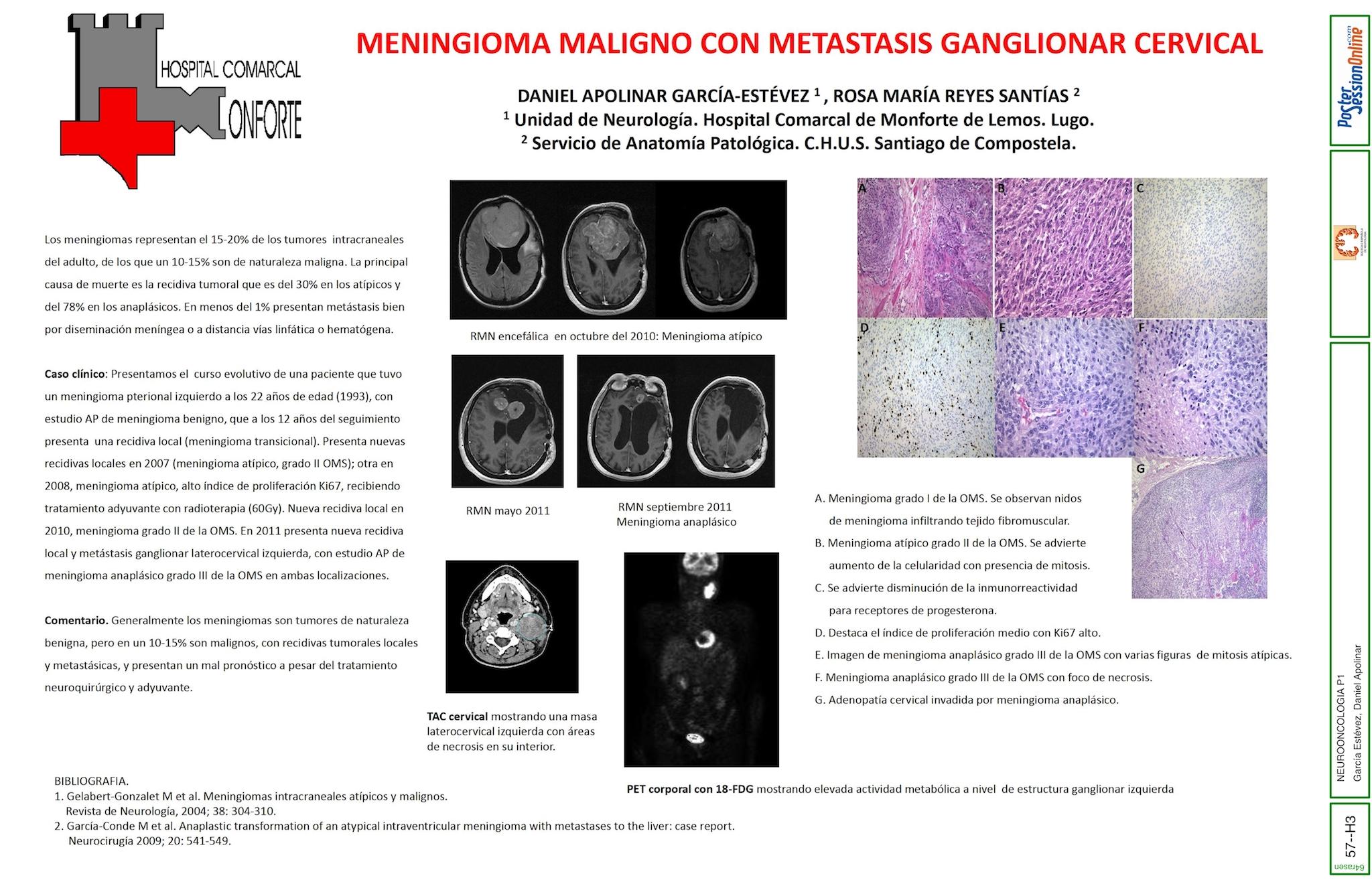 MENINGIOMA MALIGNO CON METASTASIS GANGLIONAR CERVICAL