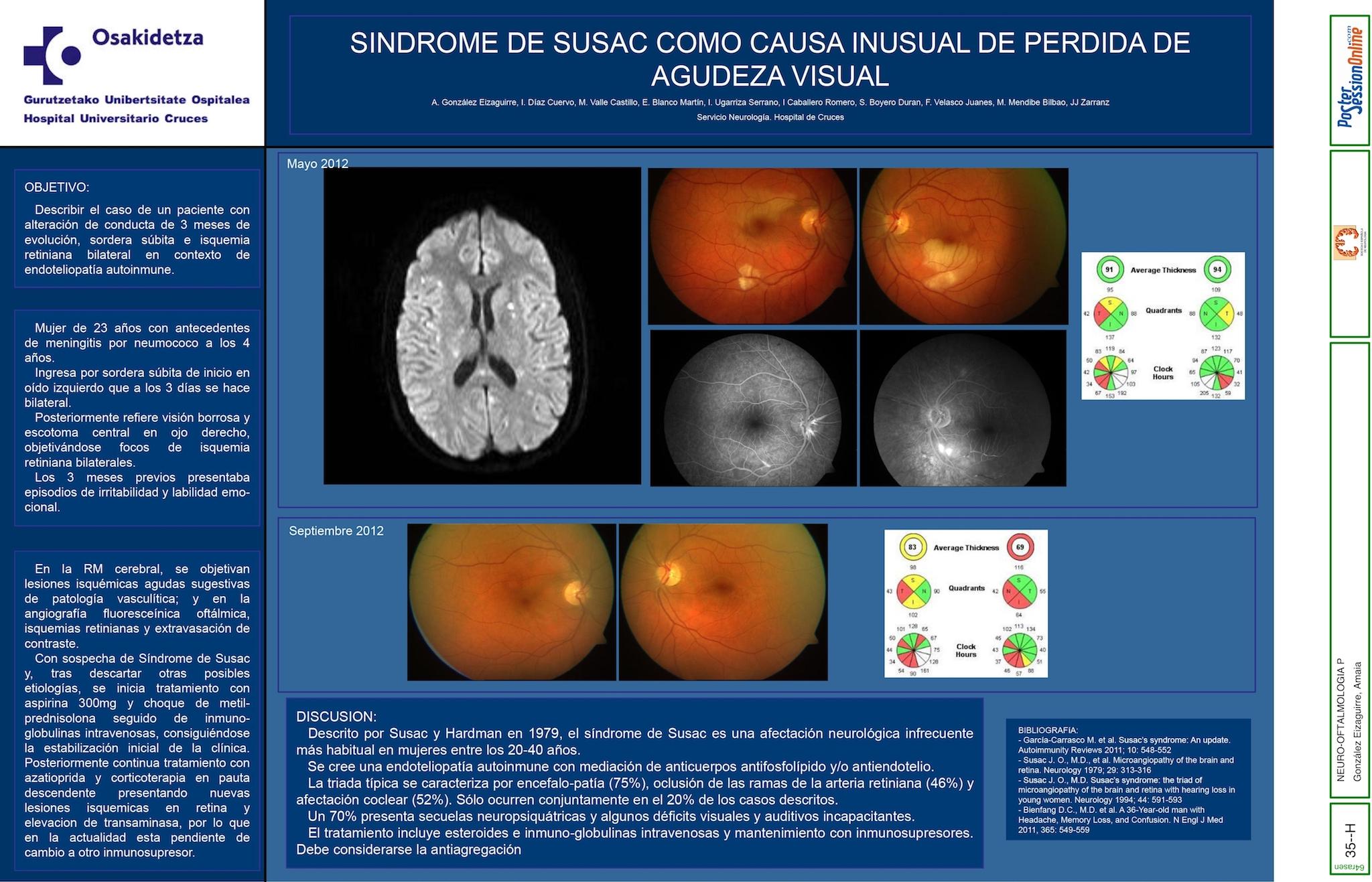 SINDROME DE SUSAC COMO CAUSA INUSUAL DE PERDIDA DE AGUDEZA VISUAL