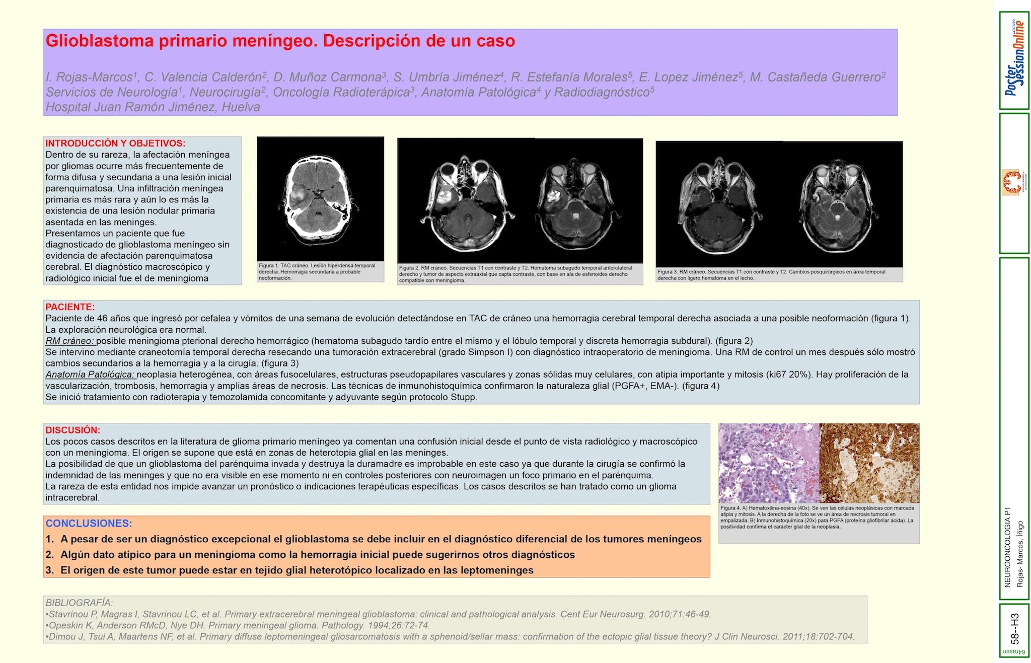 Glioblastoma primario meníngeo. Descripción de un caso