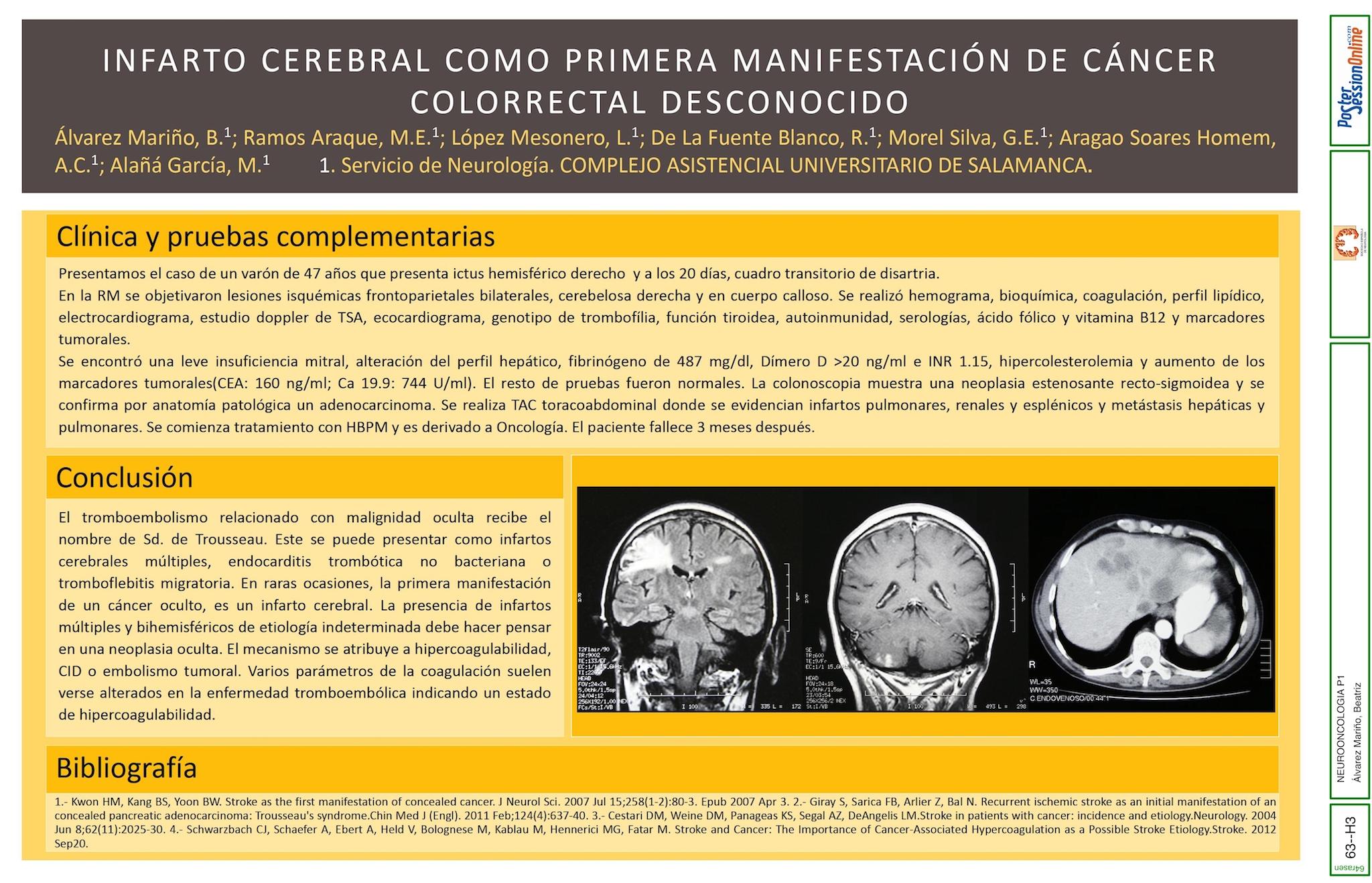 Infarto cerebral como primera manifestación de cáncer colorrectal desconocido