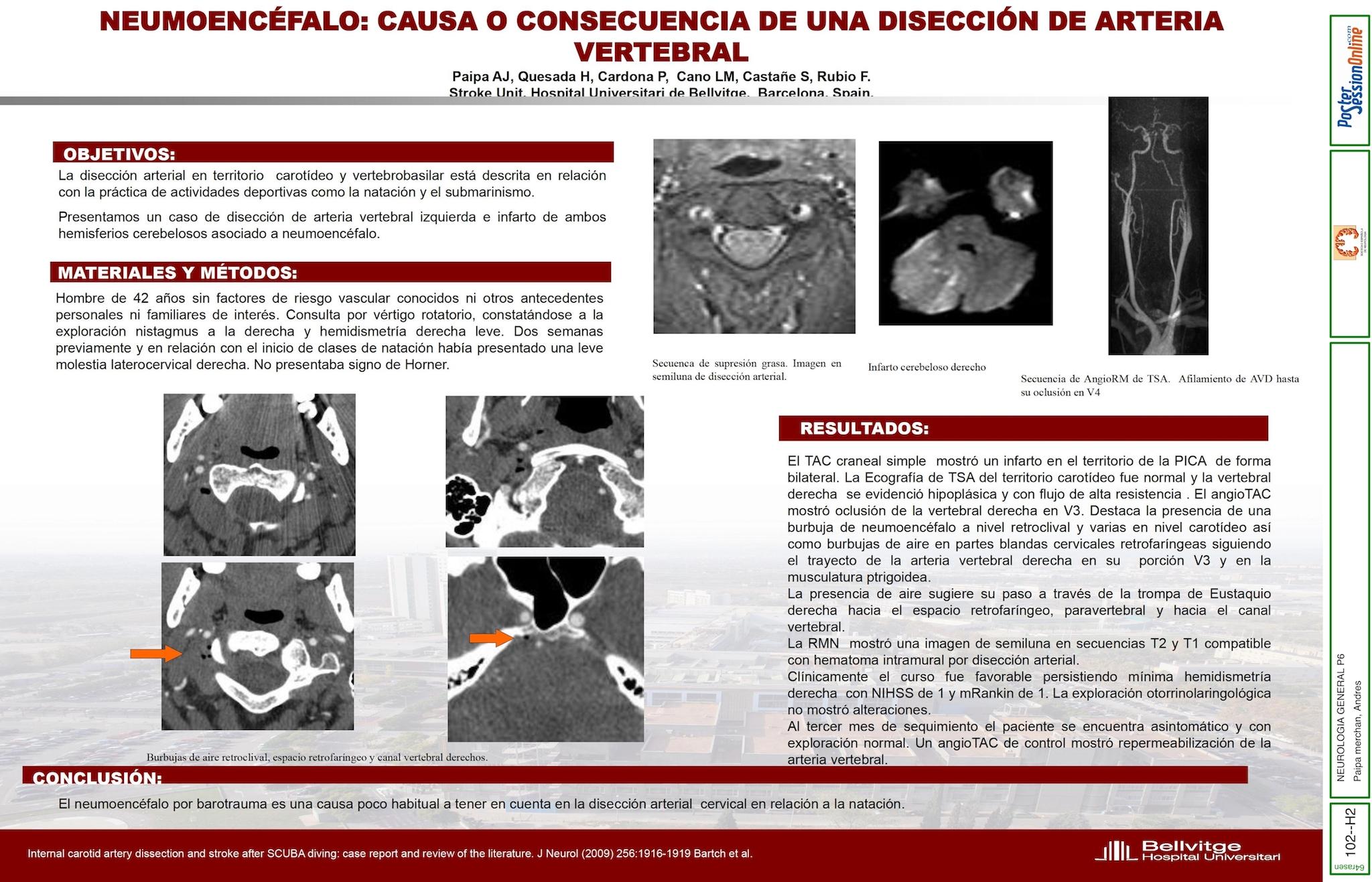 Neumoencéfalo: causa o consecuencia de una disección de arteria vertebral.