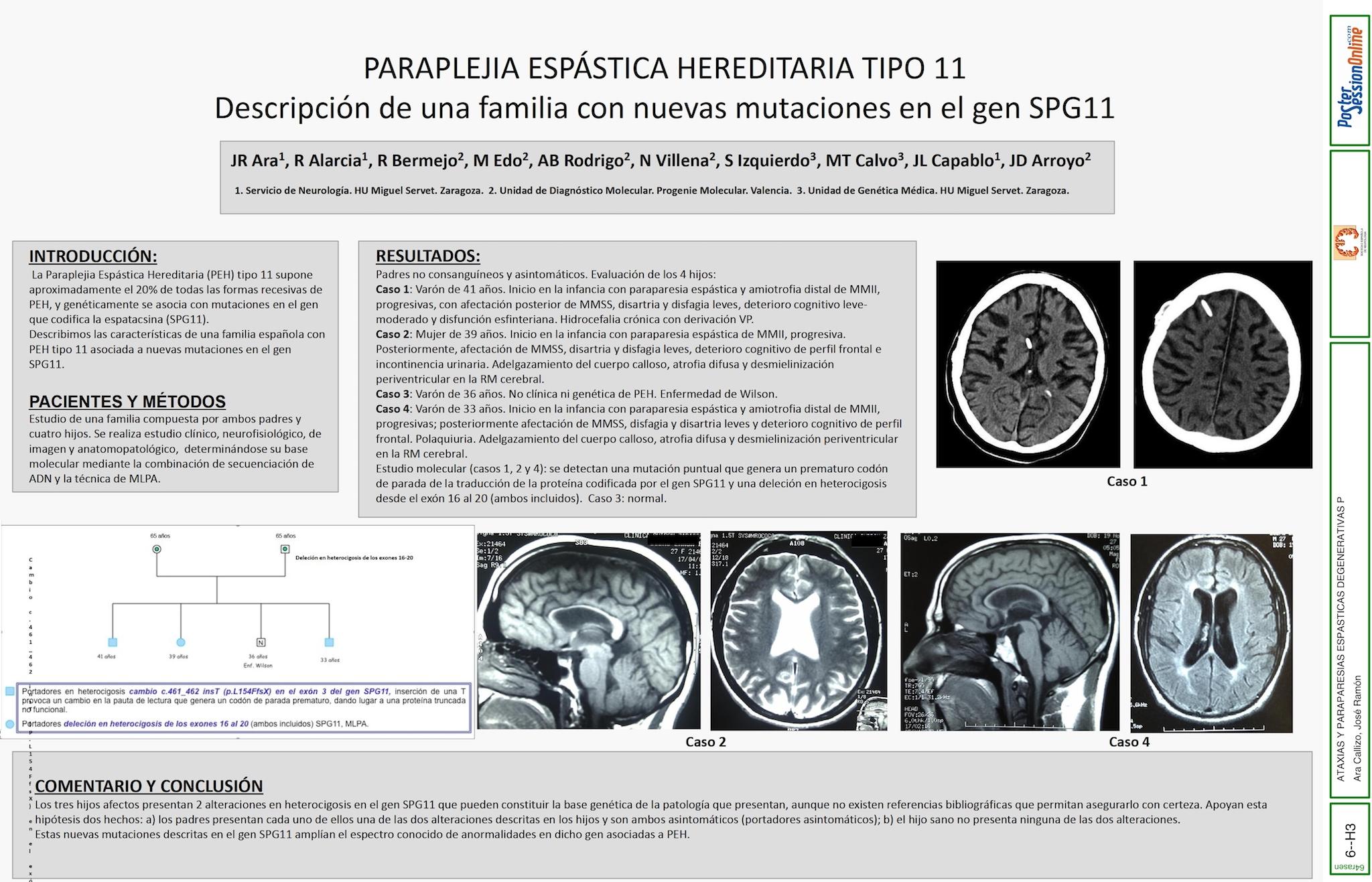 PARAPLEJIA ESPÁSTICA HEREDITARIA TIPO 11. Descripción de una familia con nuevas mutaciones en el gen SPG11