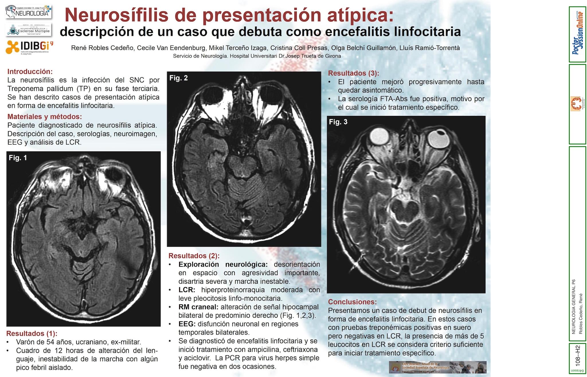 Neurosífilis de presentación atípica: descripción de un caso que debuta como encefalitis linfocitaria