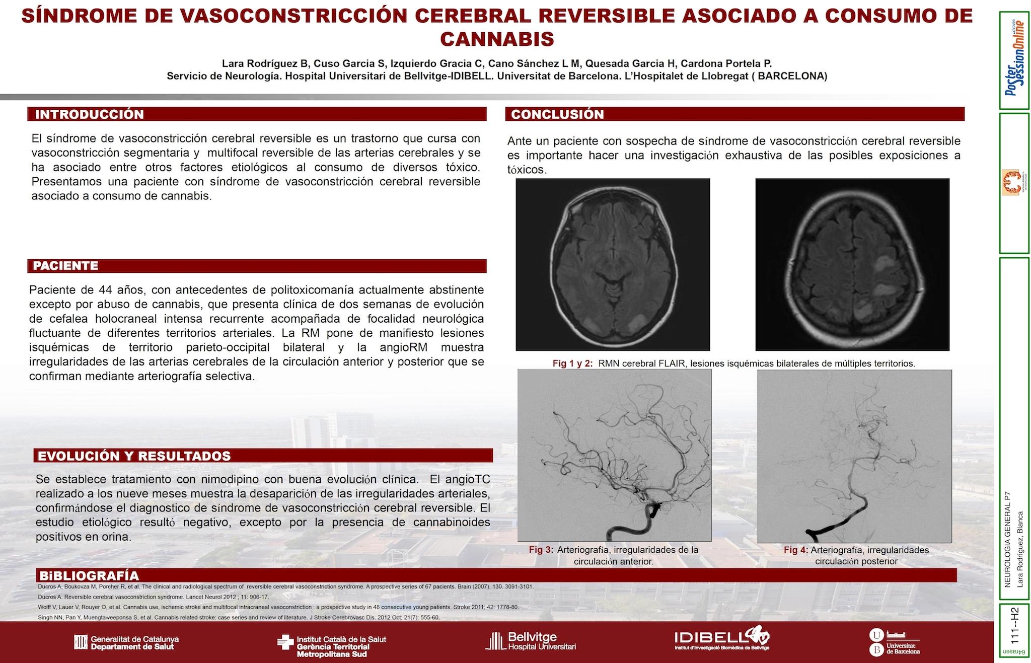 SÍNDROME DE VASOCONSTRICCIÓN CEREBRAL REVERSIBLE ASOCIADO A CONSUMO DE CANNABIS