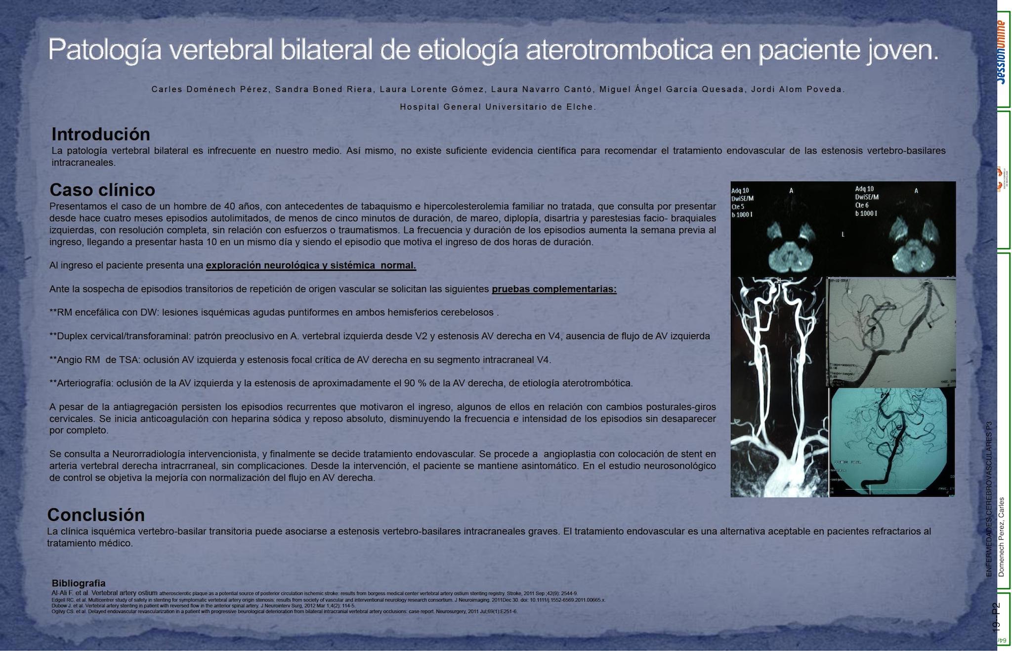 PatologÃ­a vertebral bilateral de etiologÃ­a aterotrombotica en paciente joven.