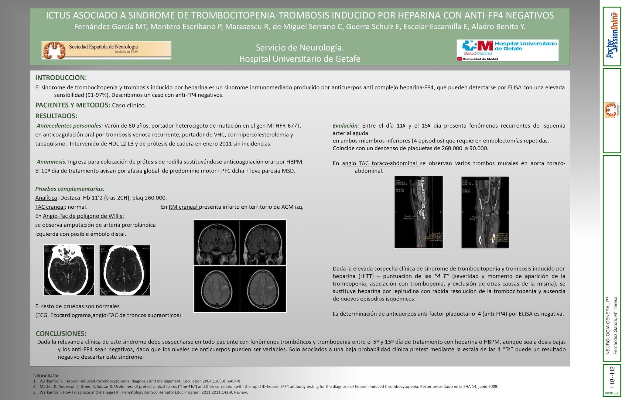 ICTUS ASOCIADO A SINDROME DE TROMBOCITOPENIA-TROMBOSIS INDUCIDO POR HEPARINA CON ANTI-FP4 NEGATIVOS.