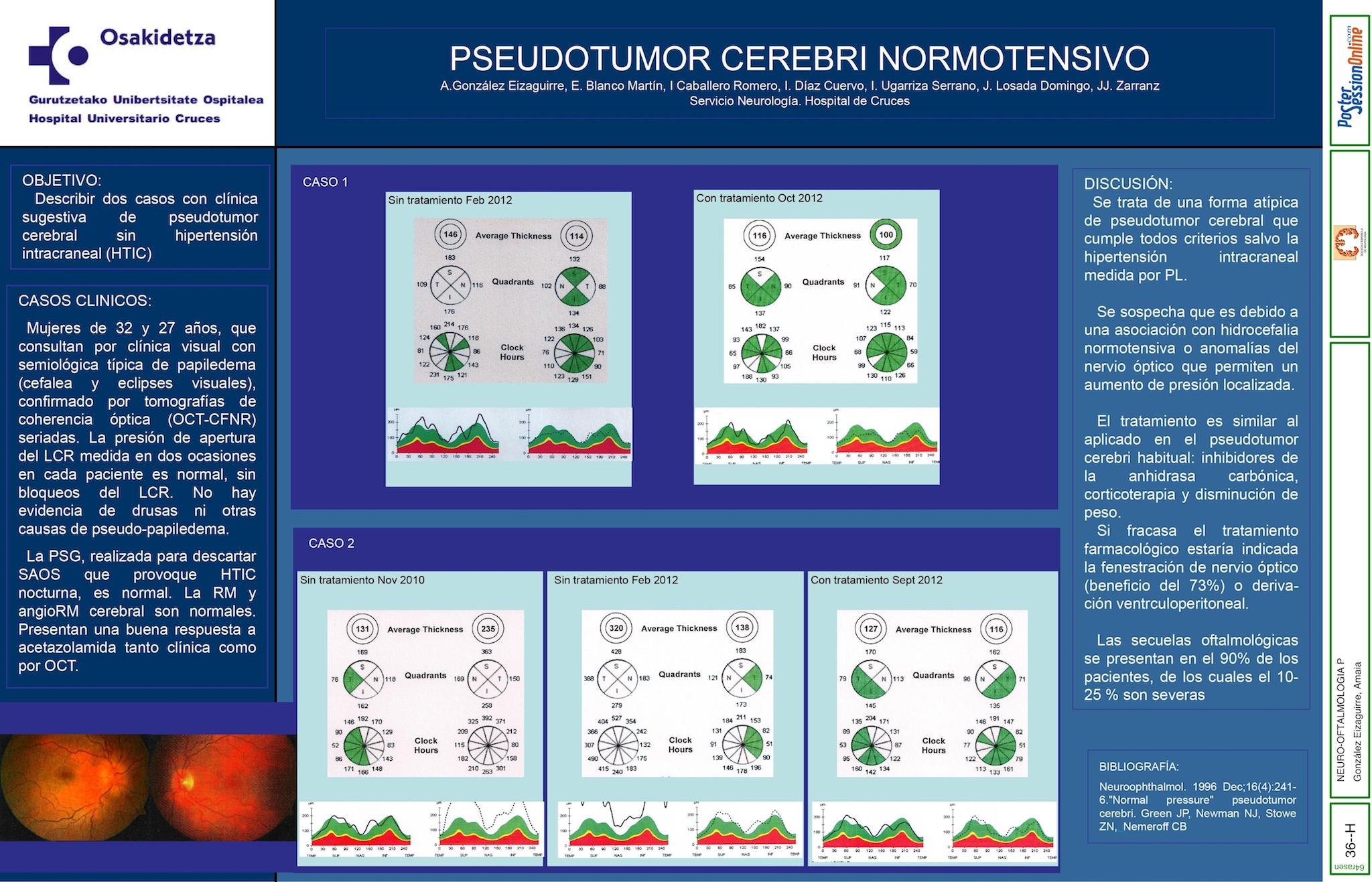 PSEUDOTUMOR CEREBRI NORMOTENSIVO