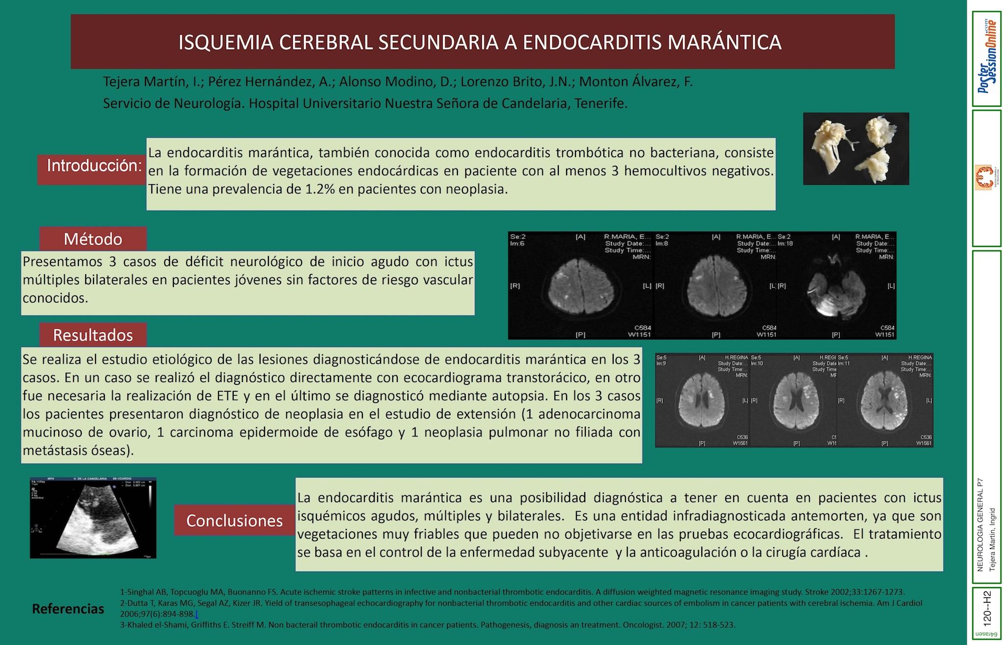 ISQUEMIA CEREBRAL SECUNDARIA A ENDOCARDITIS MARÁNTICA