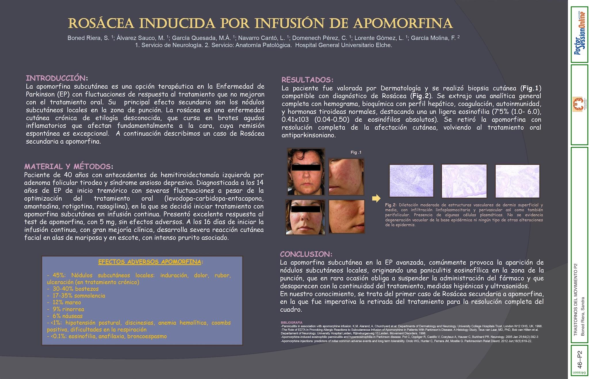 Rosácea inducida por infusión de Apomorfina